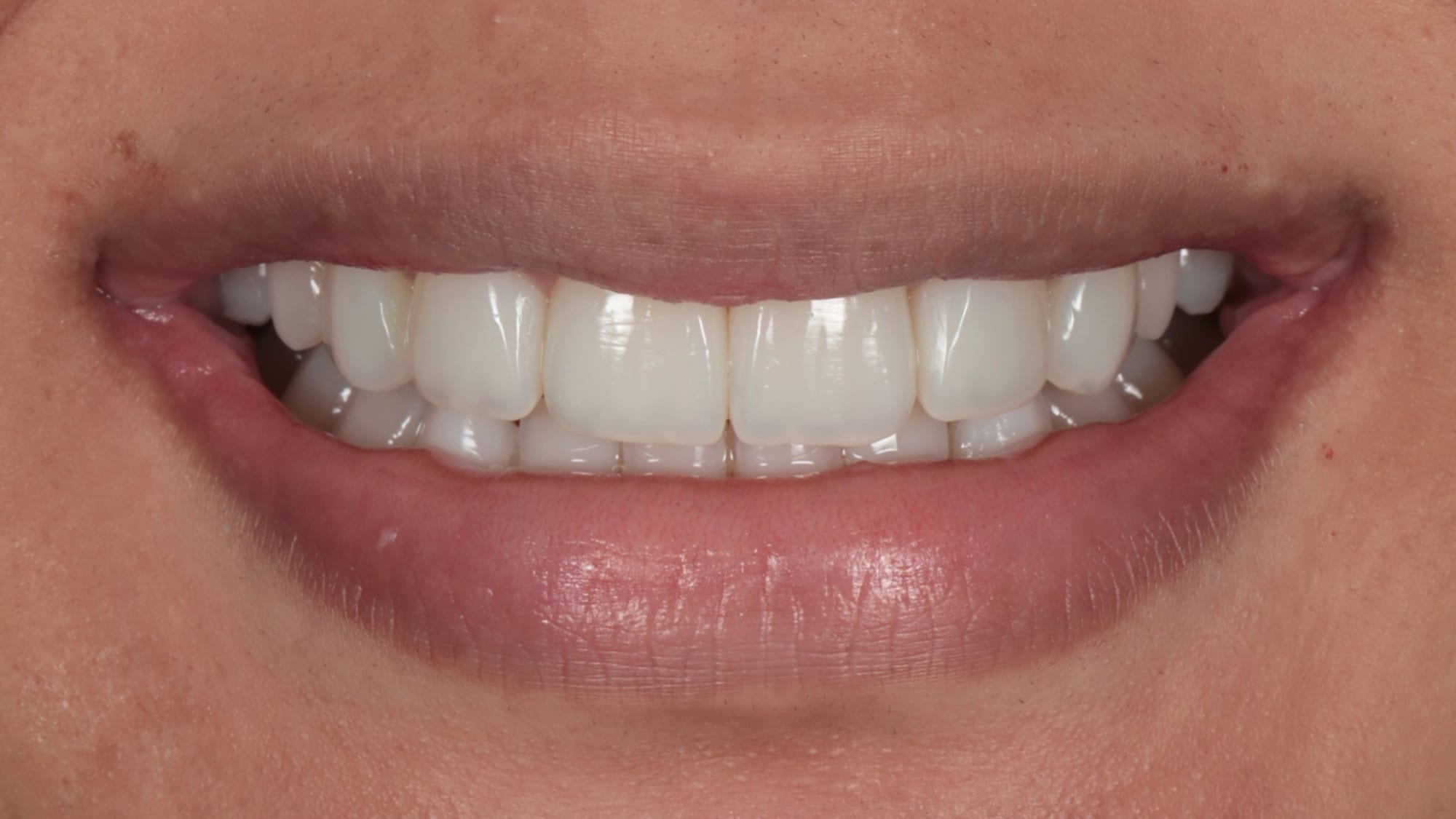 After — 6x natural composites — missing lateral incisors