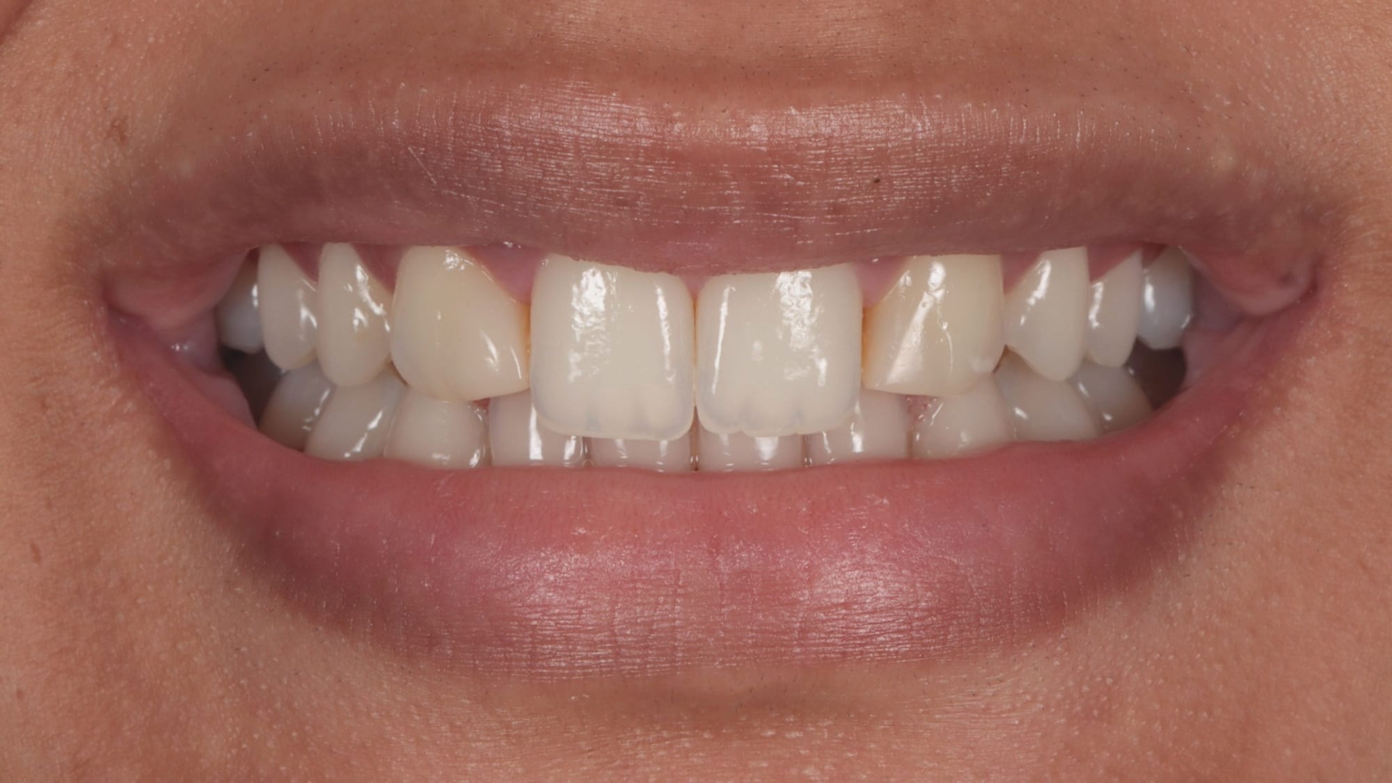 Before — 6x natural composites — missing lateral incisors