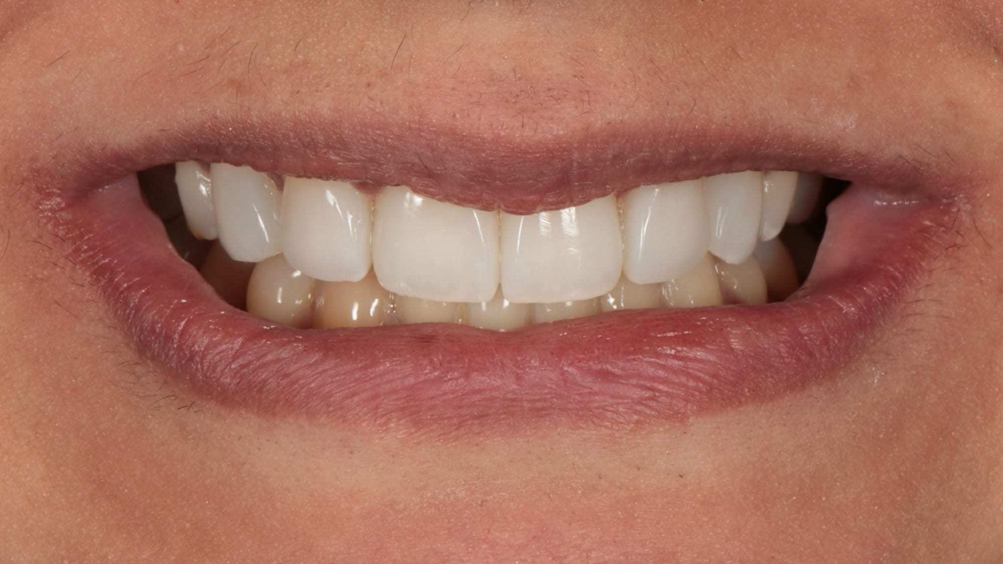 After — Invisalign & 6x natural composite veneers — missing lateral incisors