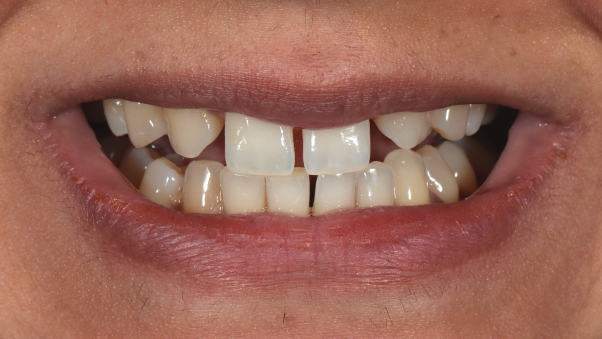 Before — Invisalign & 6x natural composite veneers — missing lateral incisors