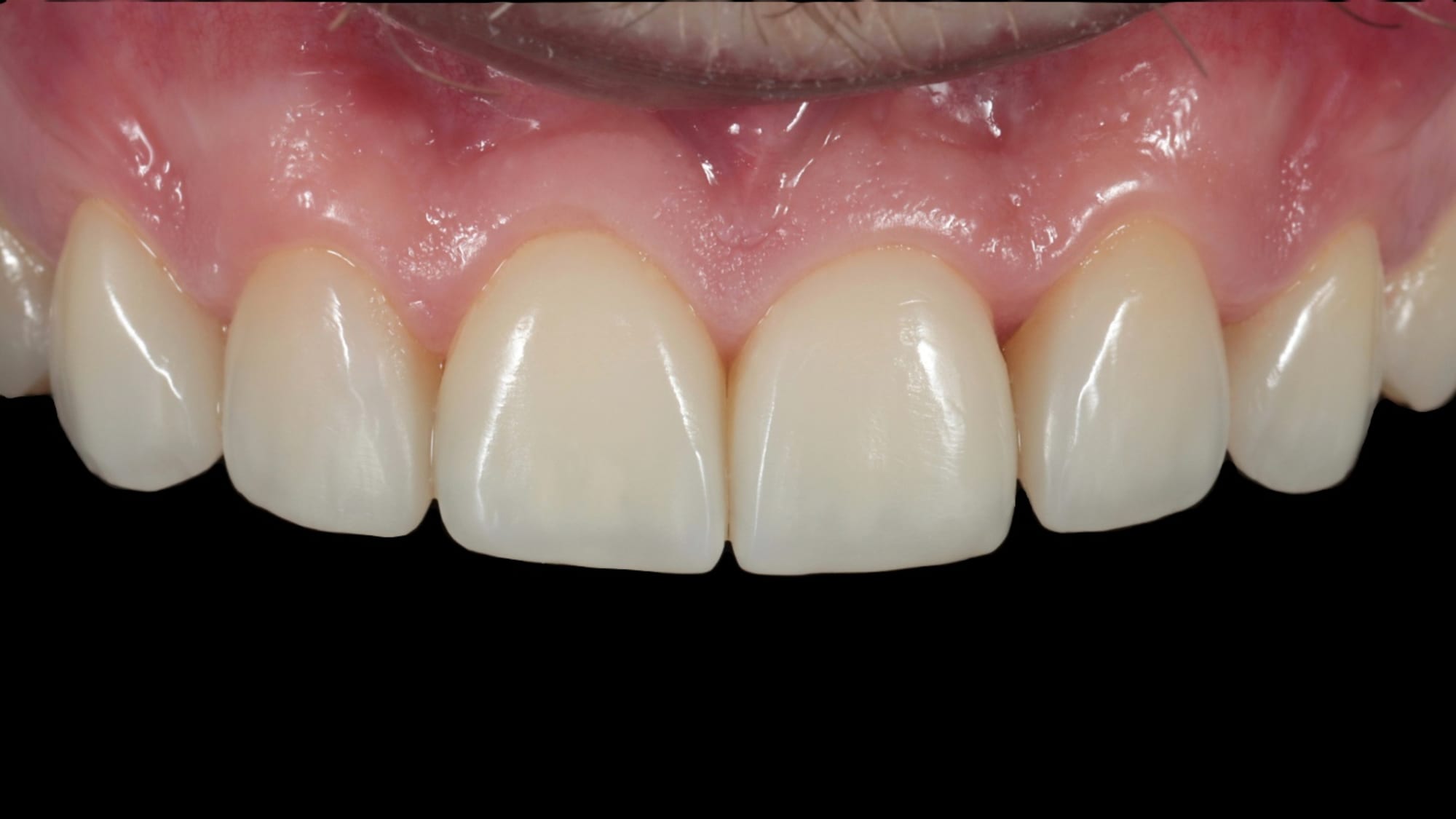 After — Missing lateral incisors, masking canines — 6x natural composite bonding/veneers