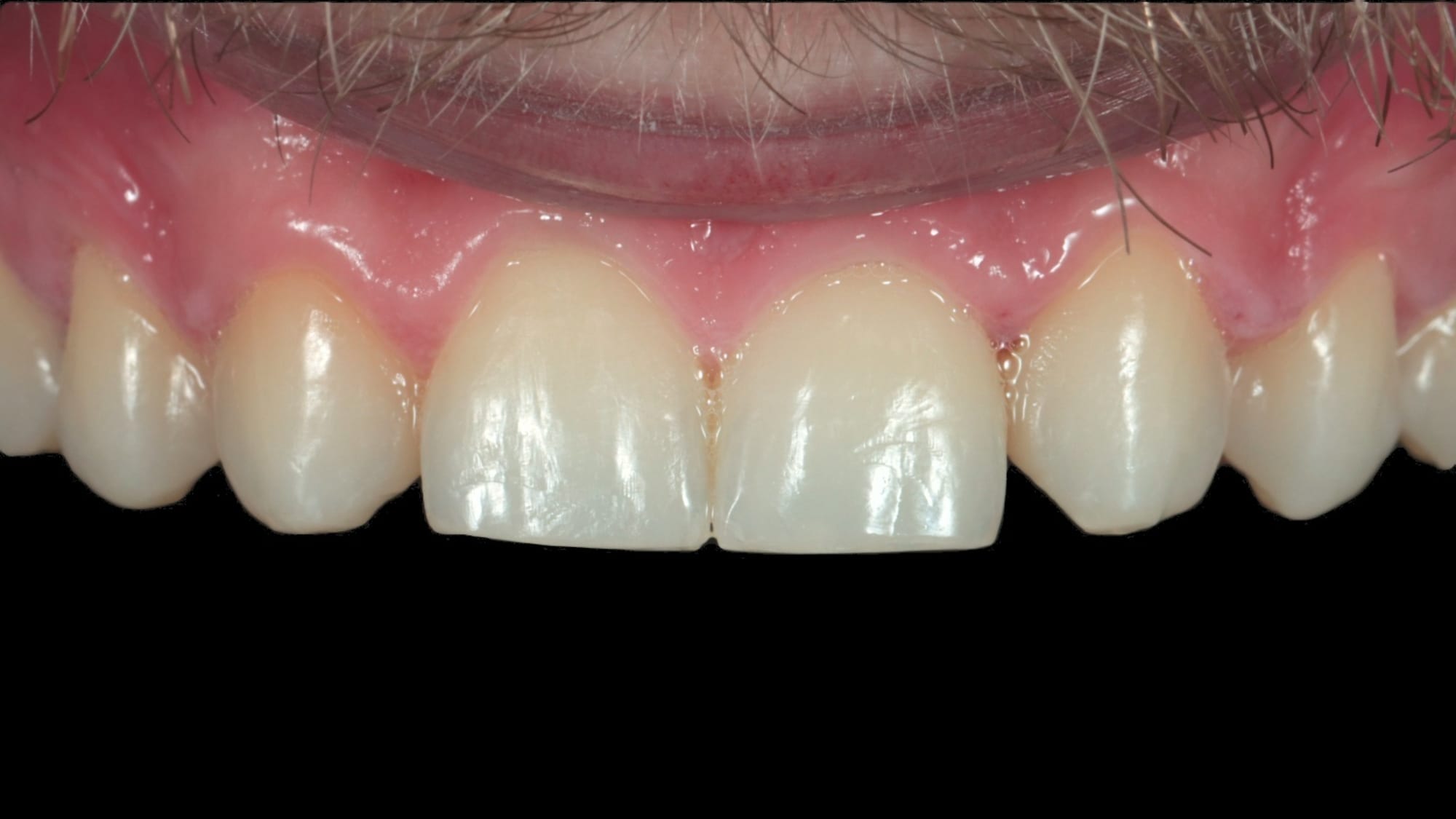 Before — Missing lateral incisors, masking canines — 6x natural composite bonding/veneers