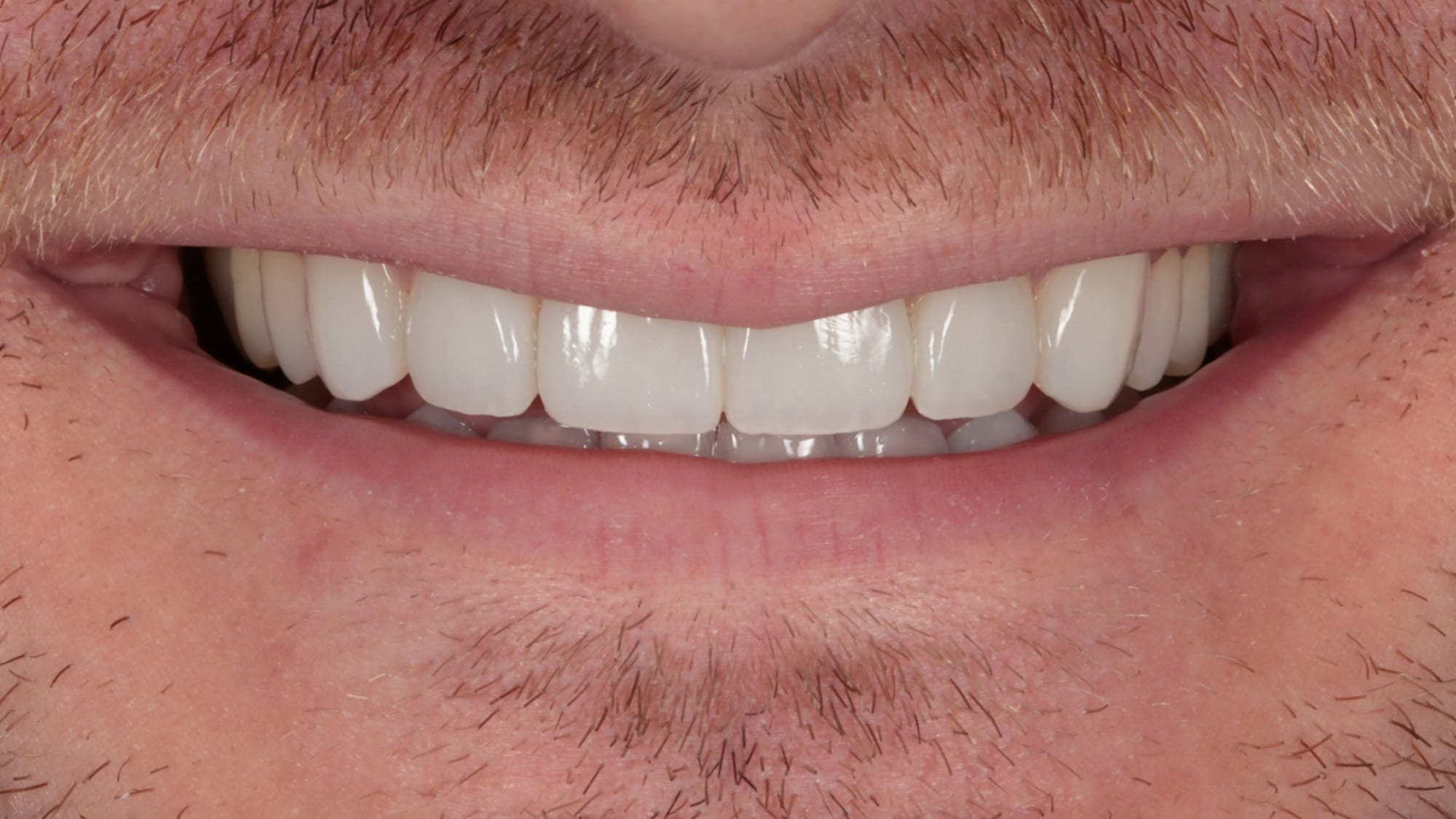 After — 4x natural composite veneers