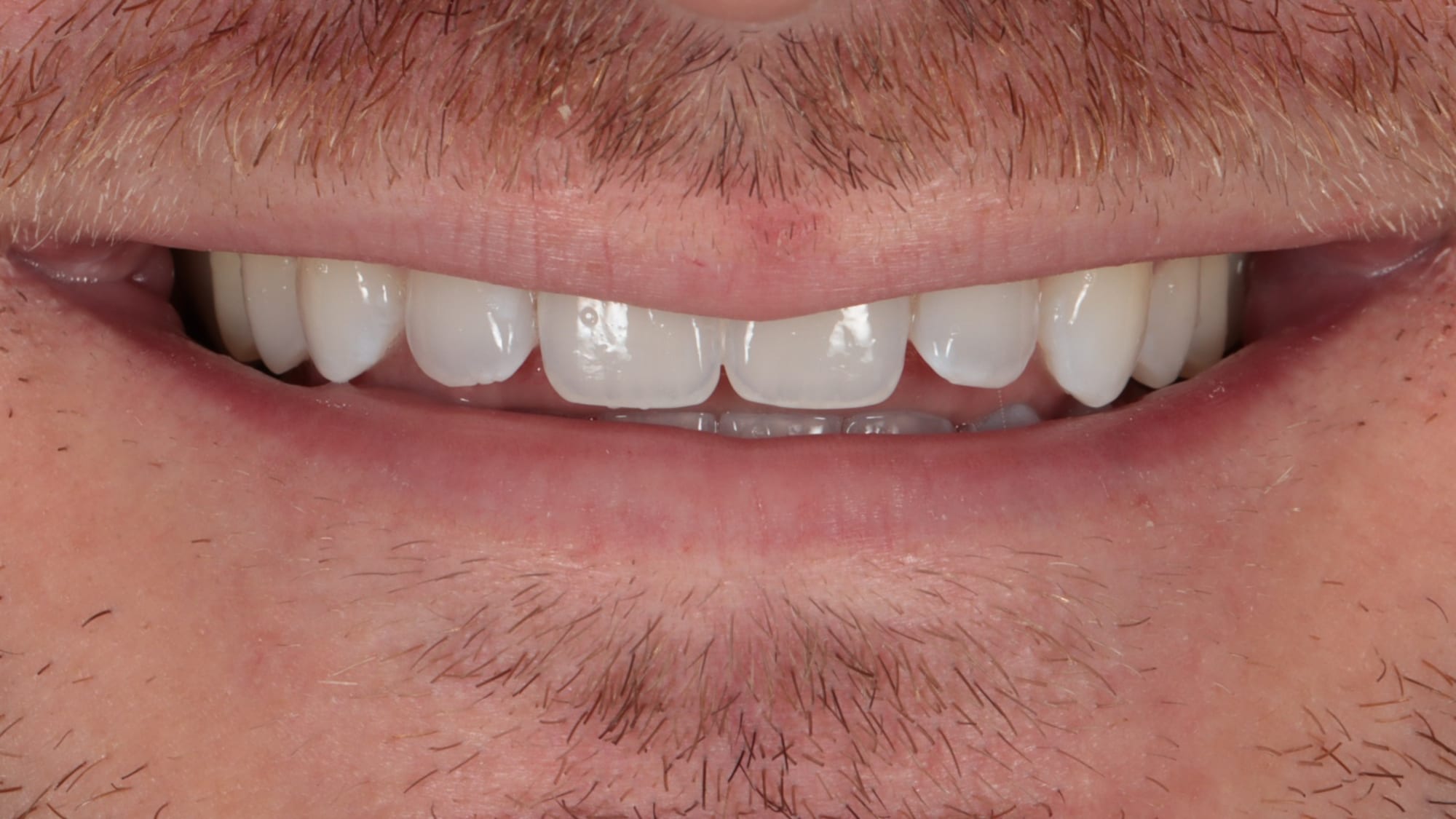 Before — 4x natural composite veneers