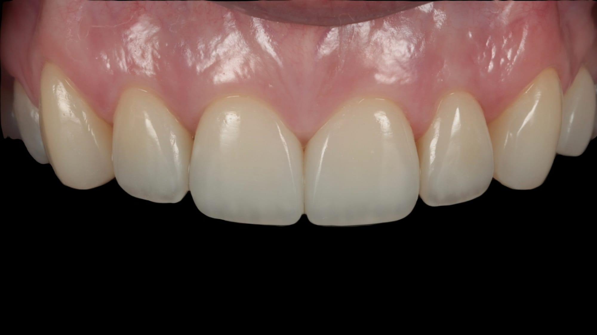 After — 6x natural composite bonding