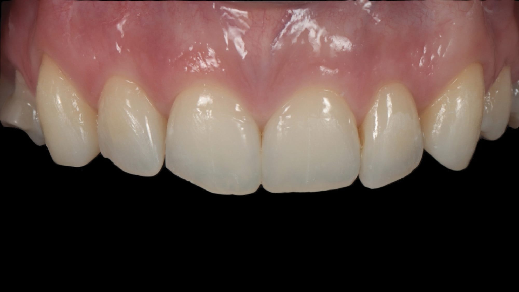 Before — 6x natural composite bonding