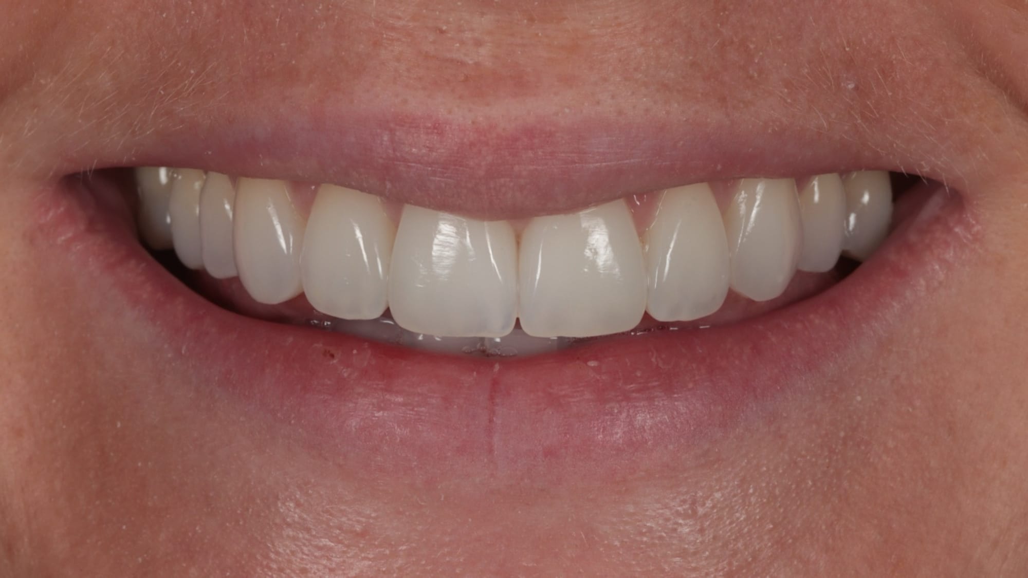After — natural composite bonding smile makeover