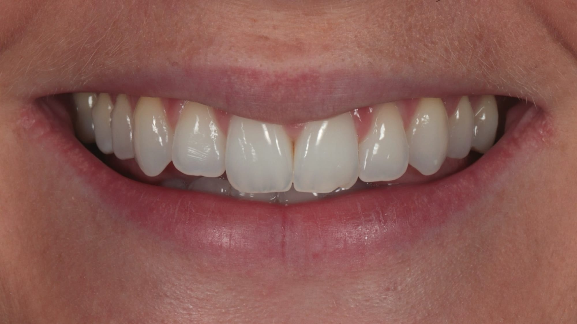 Before — natural composite bonding smile makeover