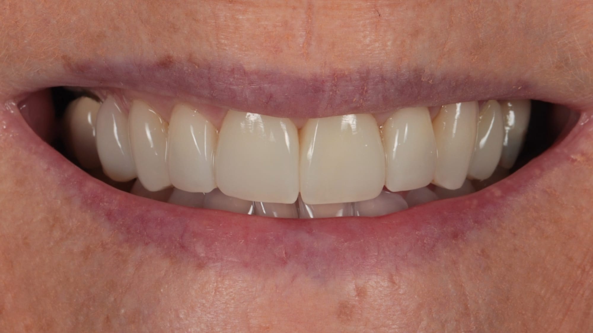 After — 10x natural composite veneers — mild crowding and narrow smile