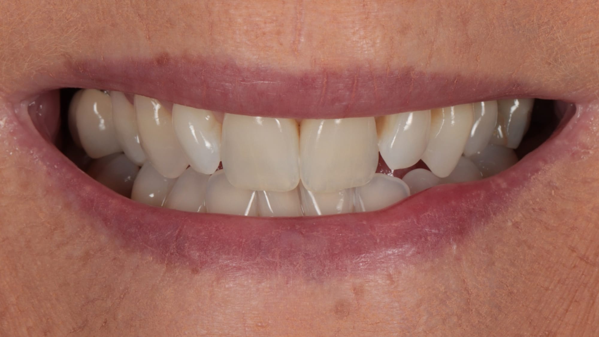 Before — 10x natural composite veneers — mild crowding and narrow smile