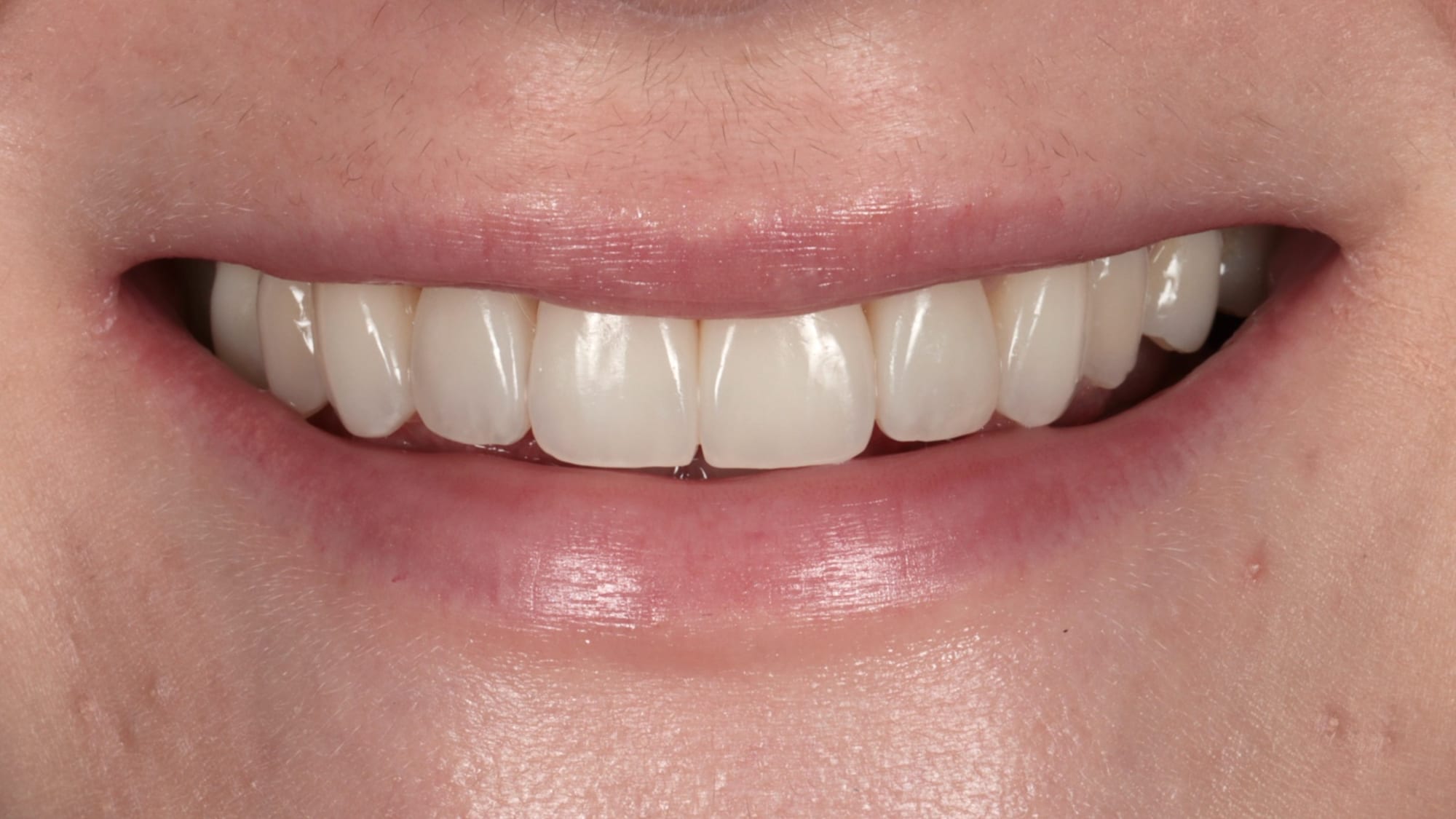 After — 6x natural-style composite bonding