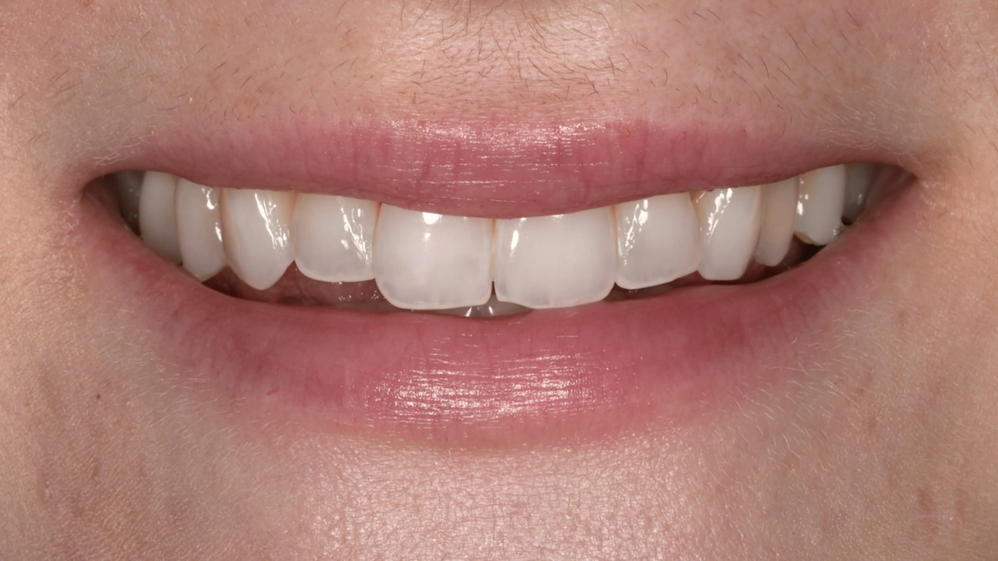 Before — 6x natural-style composite bonding