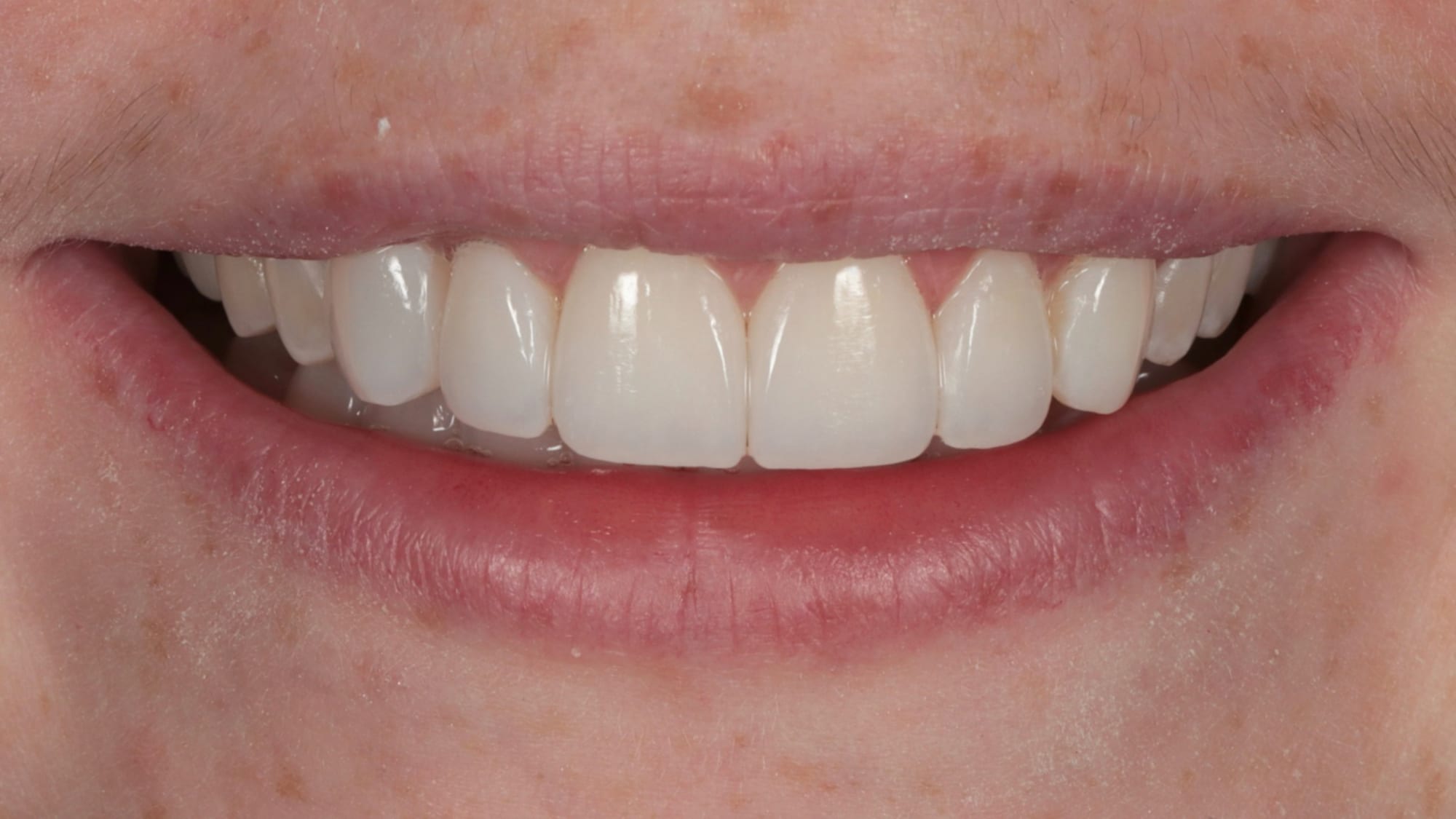 After — 6x natural composite veneers