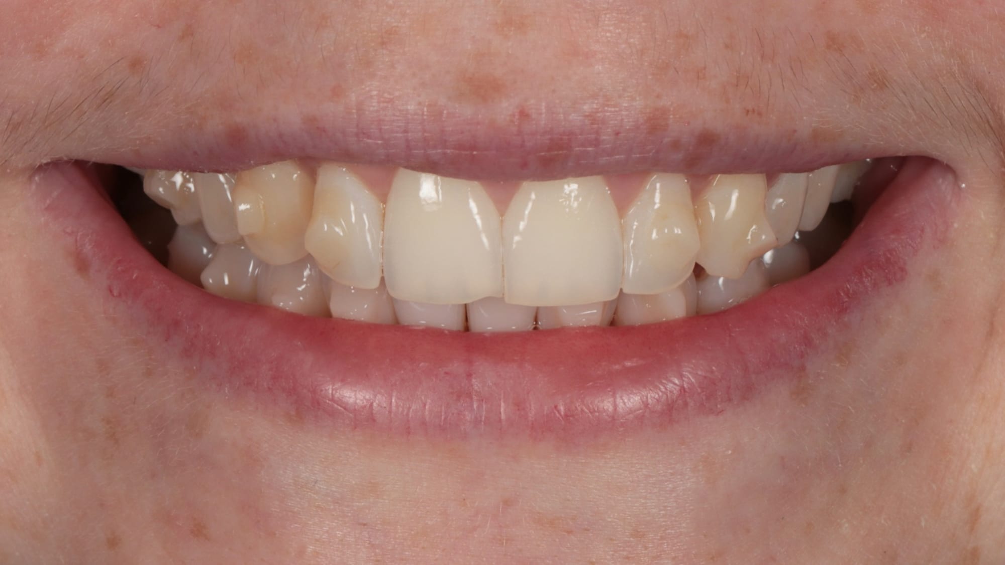 Before — 6x natural composite veneers