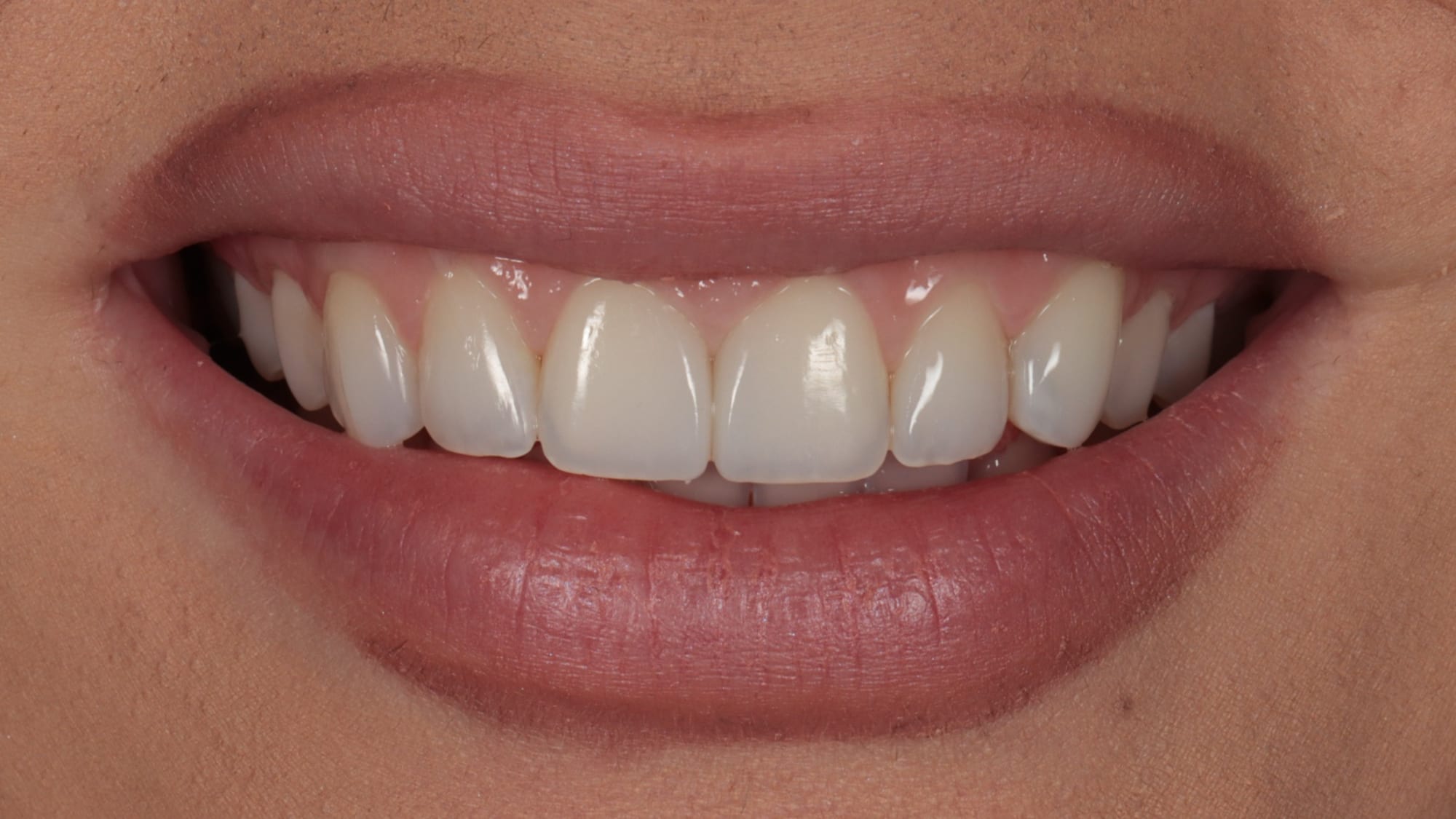 After — 6x natural composite bonding — old fillings and irregular shapes