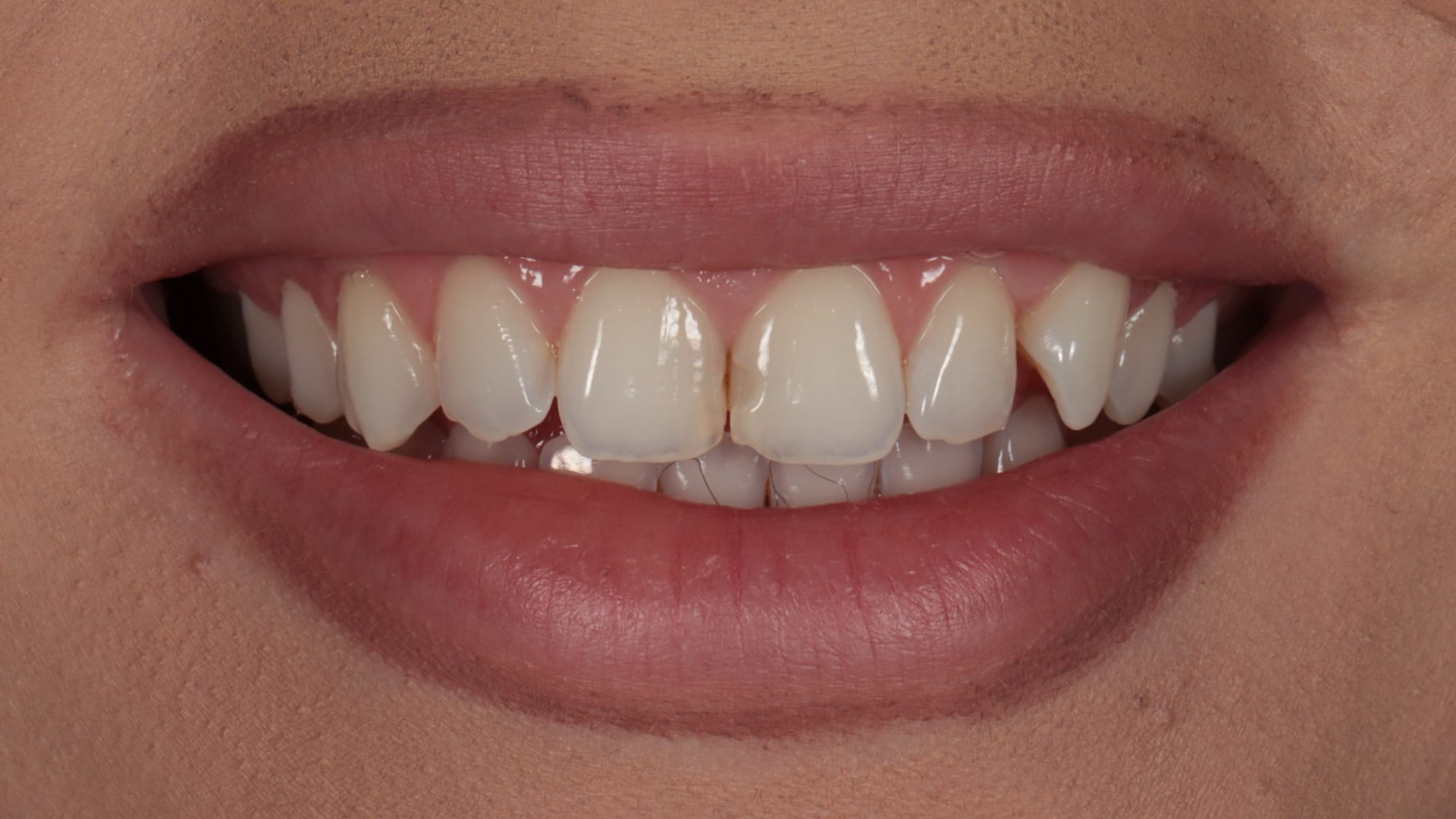 Before — 6x natural composite bonding — old fillings and irregular shapes