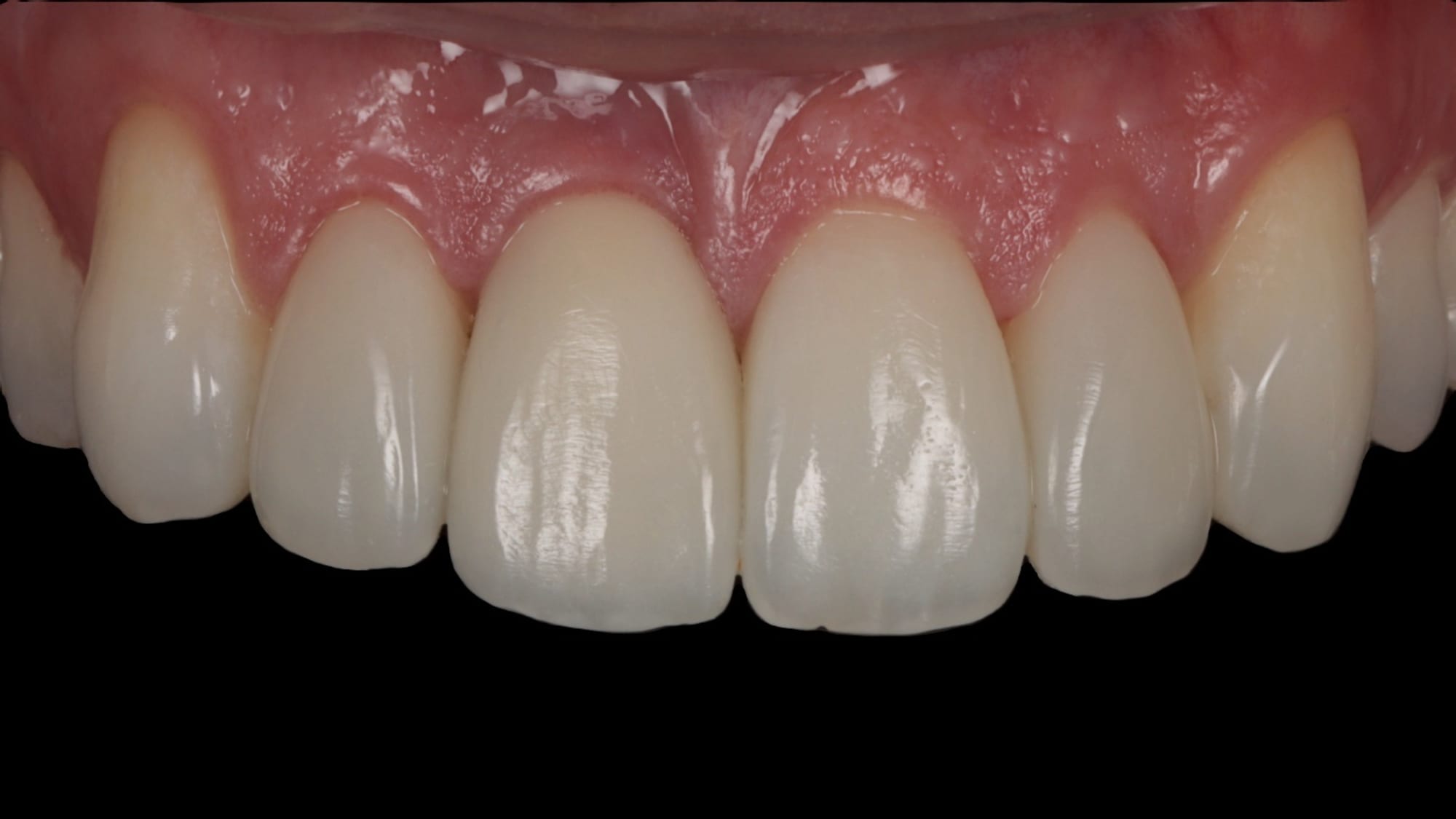 After — Peg-shaped teeth — 6x natural composite bonding/veneers