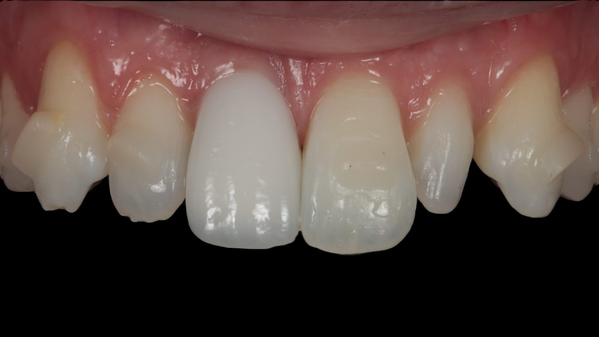 Before — Peg-shaped teeth — 6x natural composite bonding/veneers