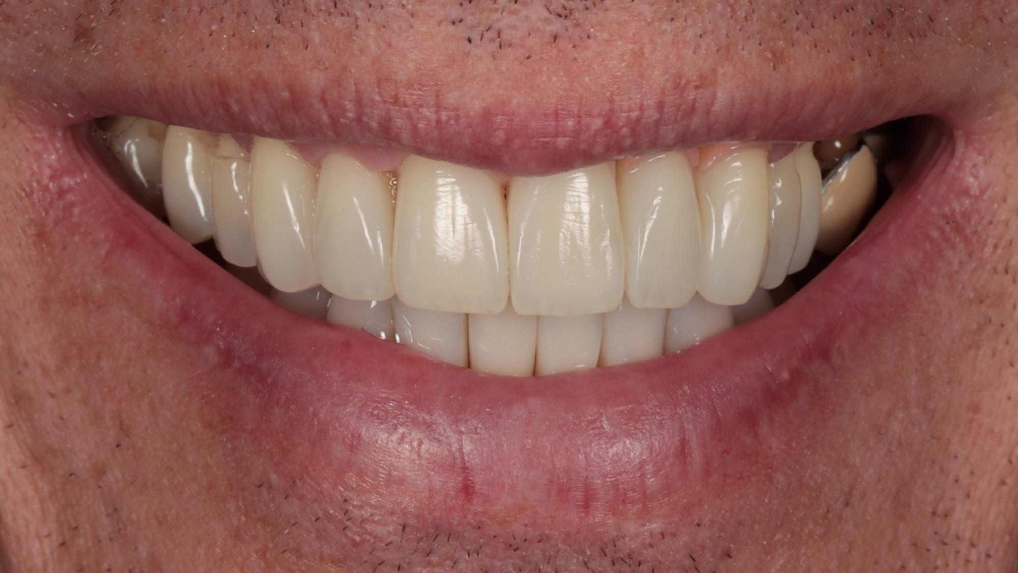 After — 12x composite bonding — receding gums & black triangles