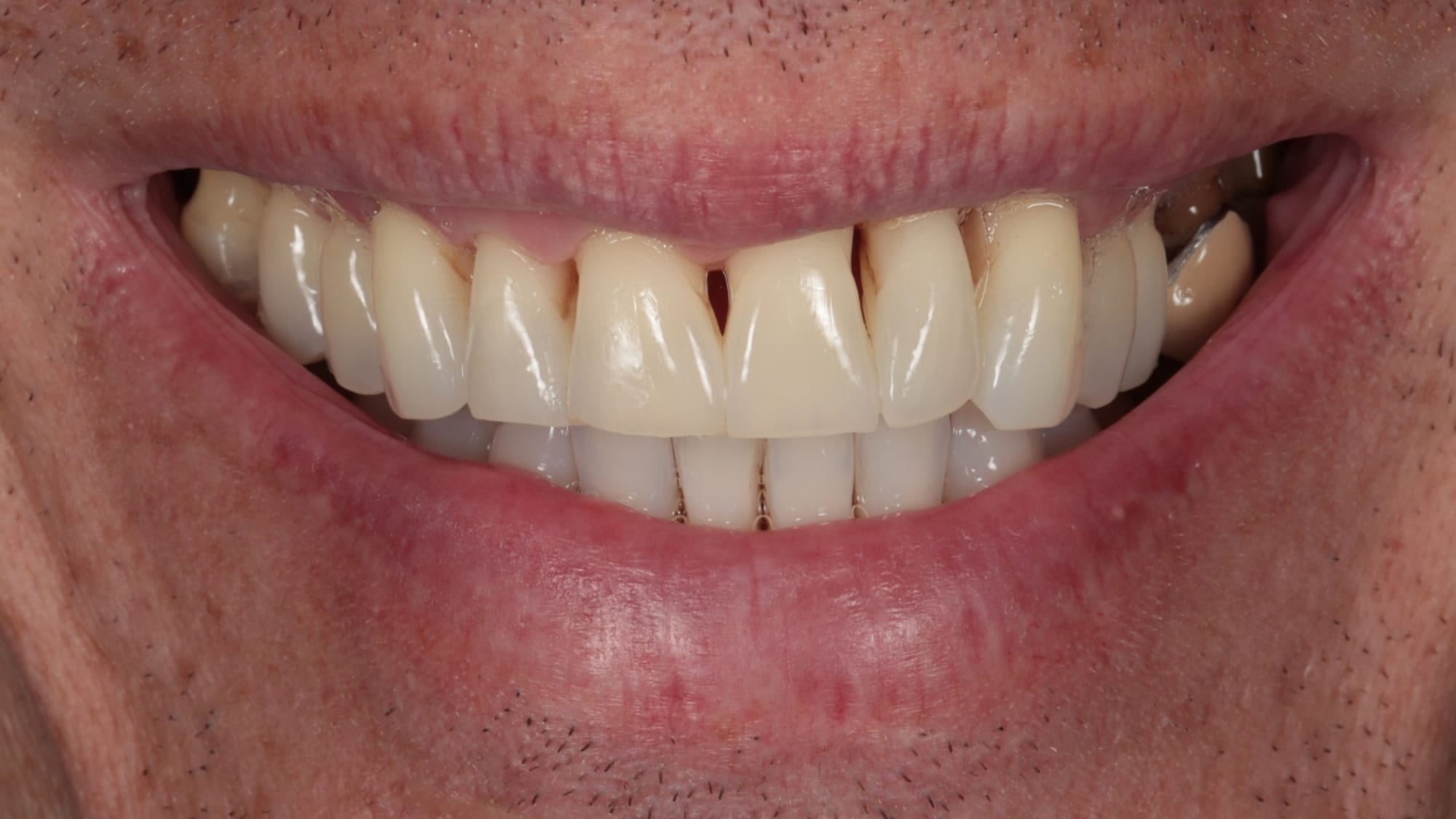 Before — 12x composite bonding — receding gums & black triangles