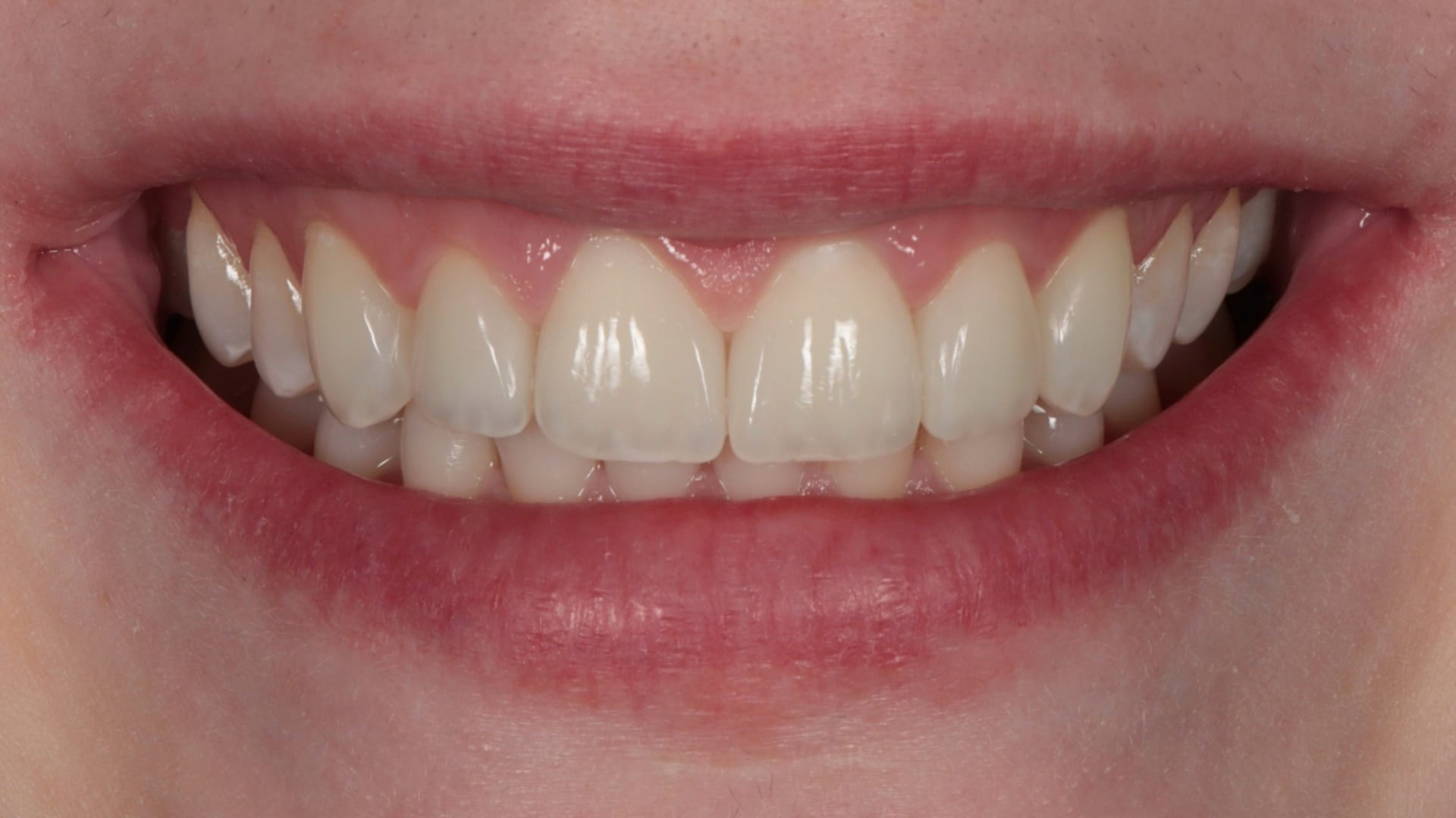 After — Replacing old bonding — 6x natural composites
