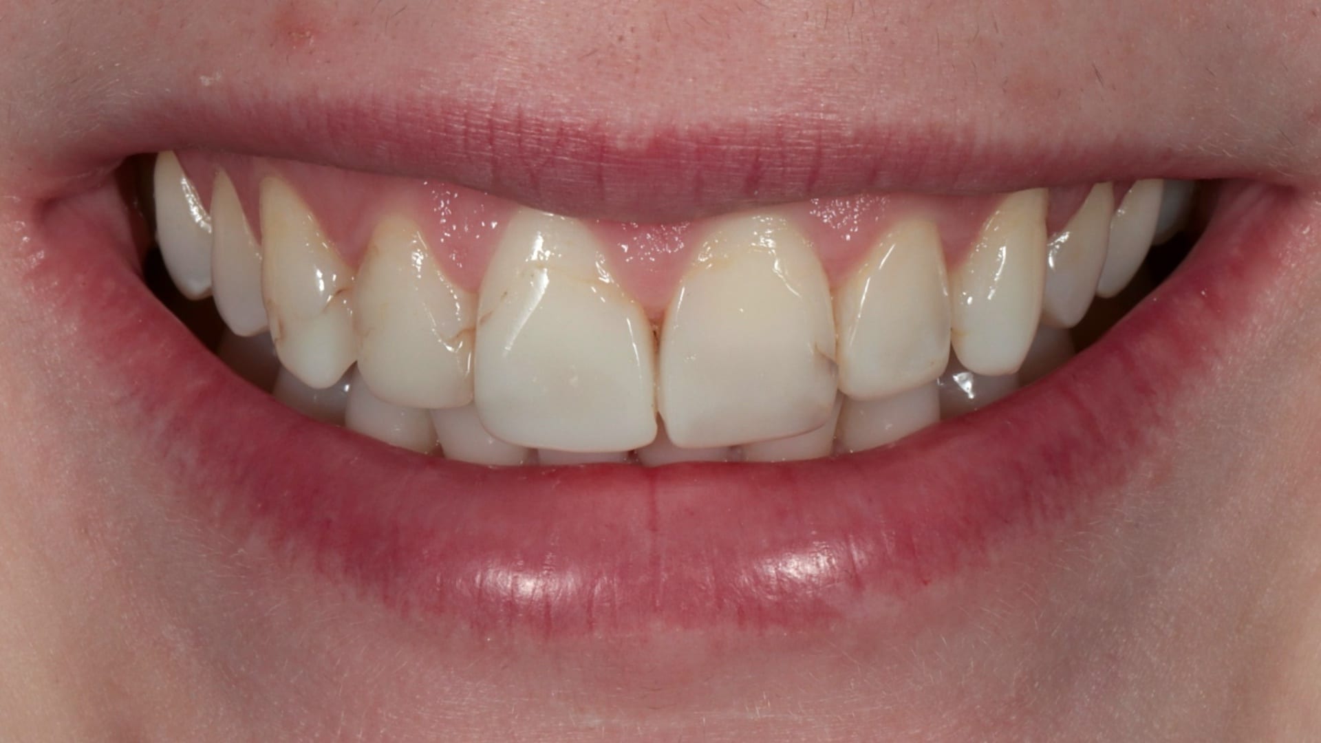 Before — Replacing old bonding — 6x natural composites