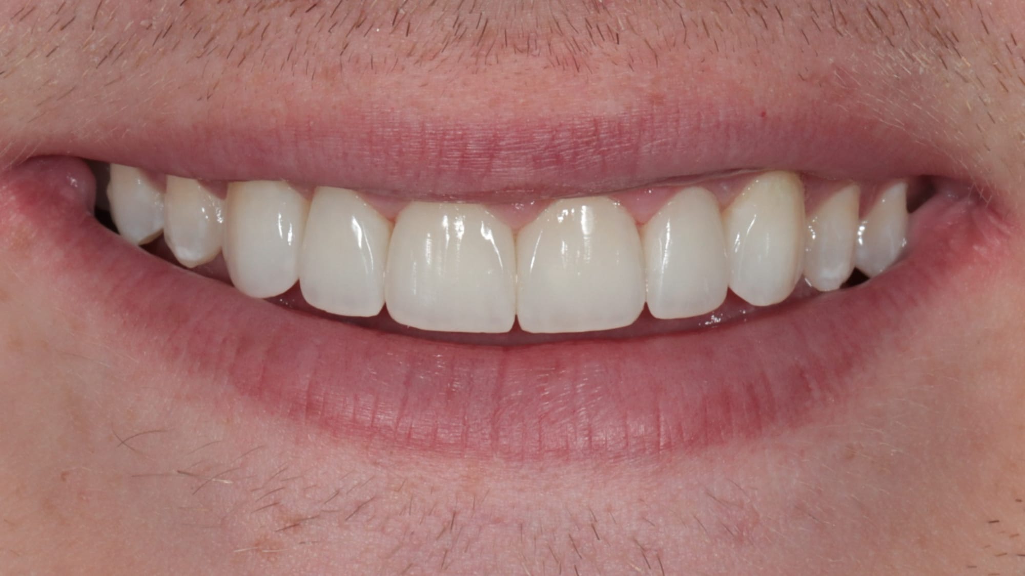 After — Replacing poorly done composite — 6x natural composite veneers