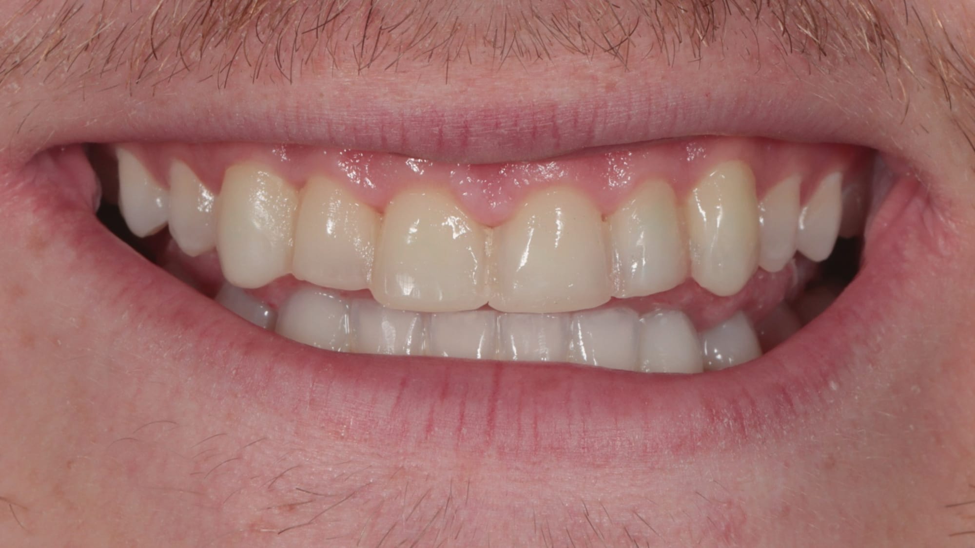 Before — Replacing poorly done composite — 6x natural composite veneers