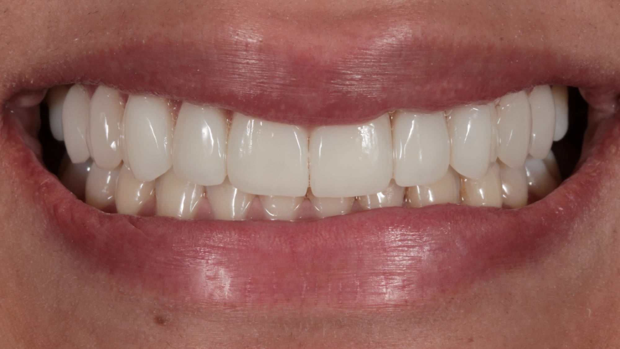 After — Restoring volume in a smile — 10x natural composite veneers