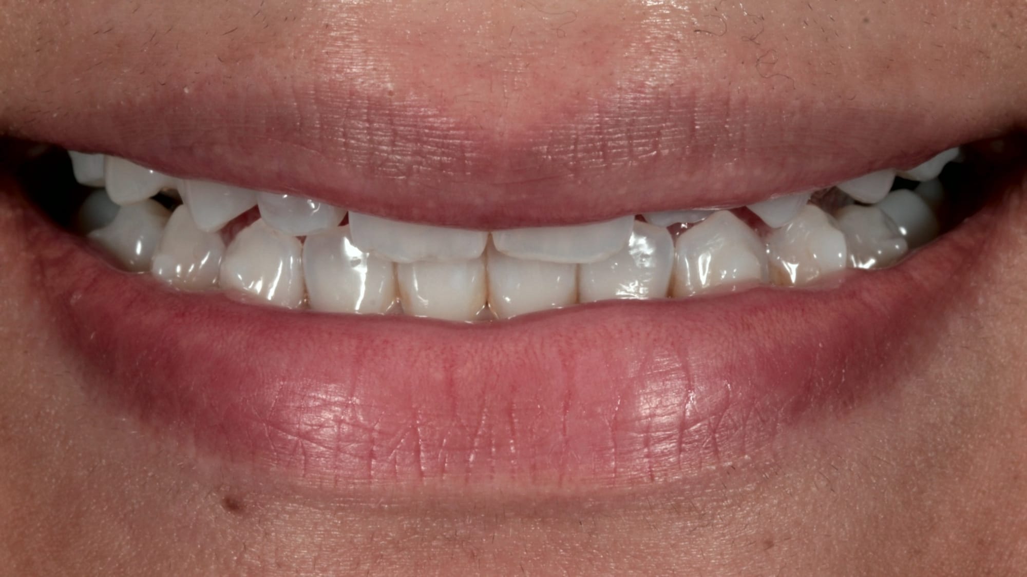 Before — Restoring volume in a smile — 10x natural composite veneers