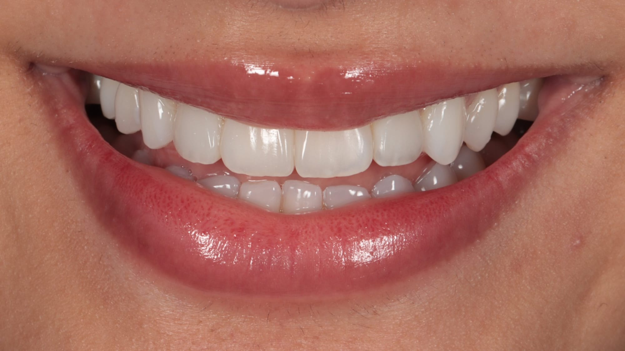 After — Correcting shapes and spaces — 4x natural composite bonding