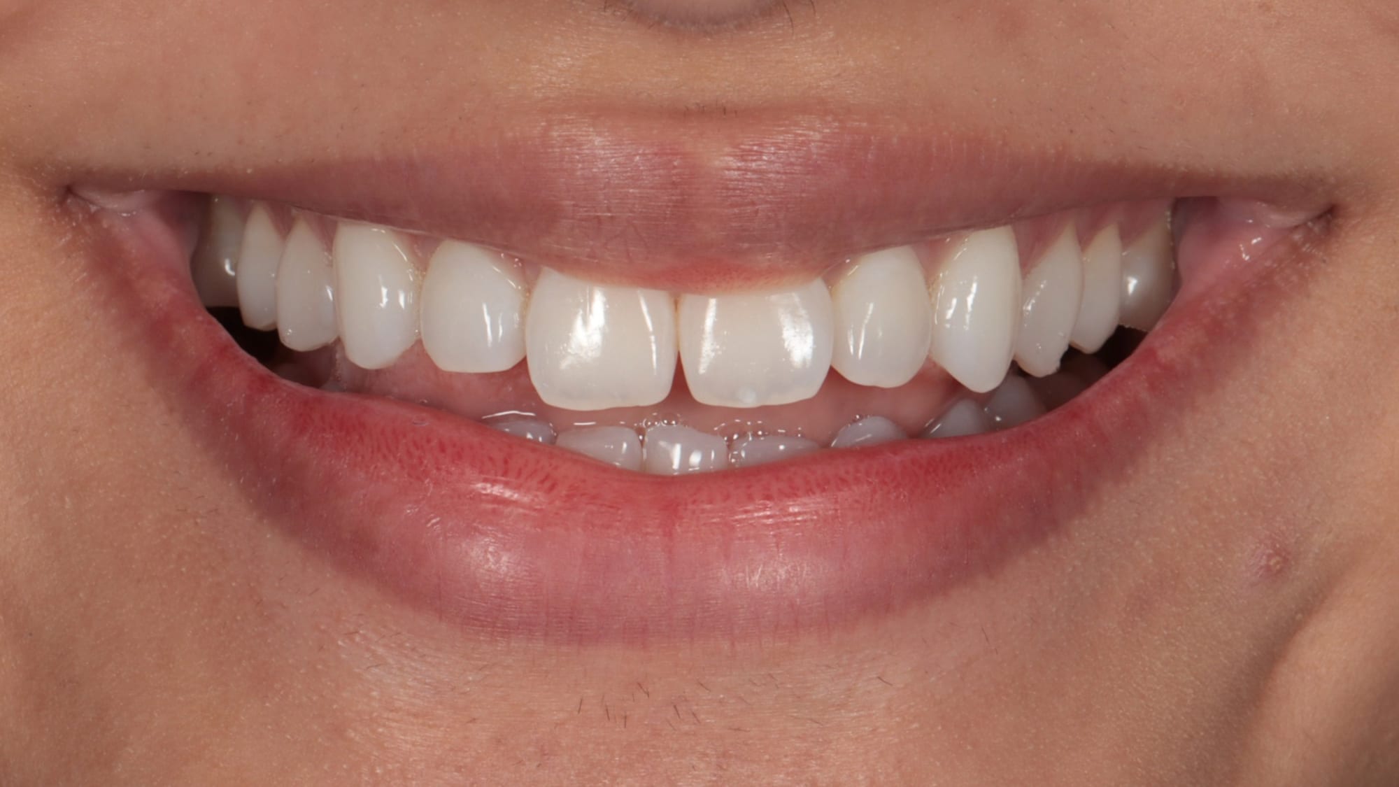 Before — Correcting shapes and spaces — 4x natural composite bonding
