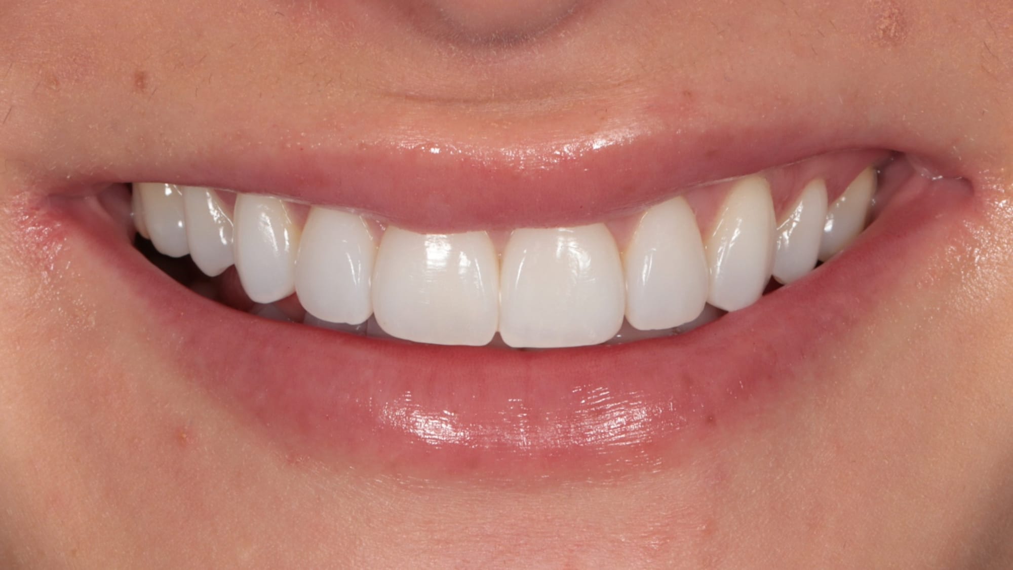 After — 6x composite bonding — squaring rounded teeth
