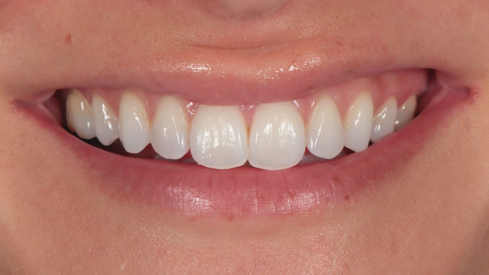 Before — 6x composite bonding — squaring rounded teeth