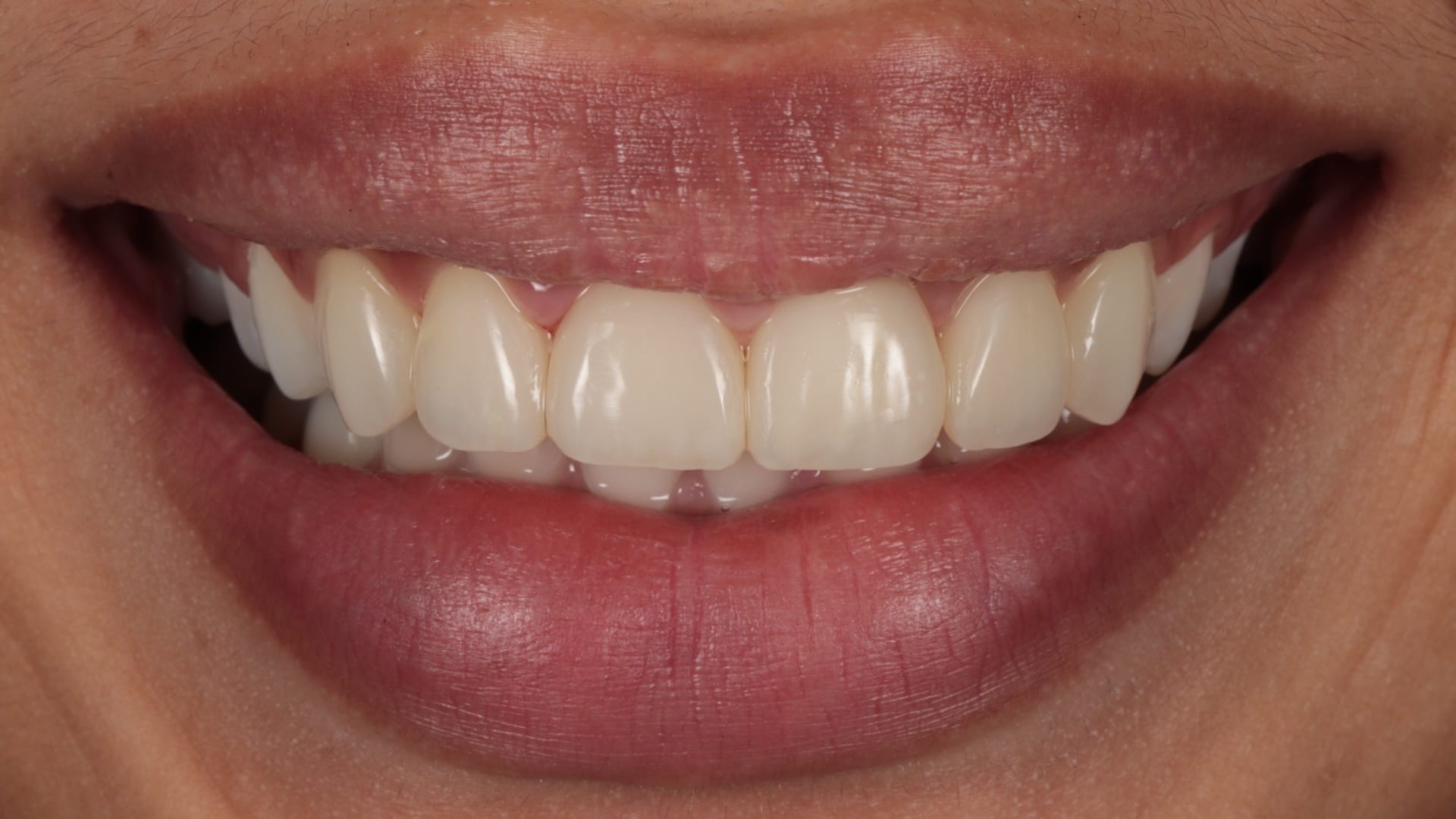 After — 6x composite veneers