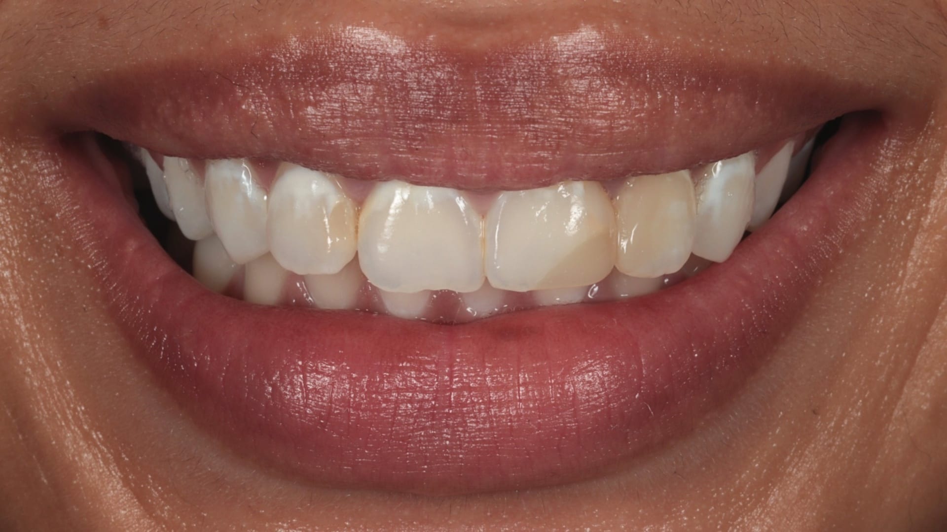 Before — 6x composite veneers