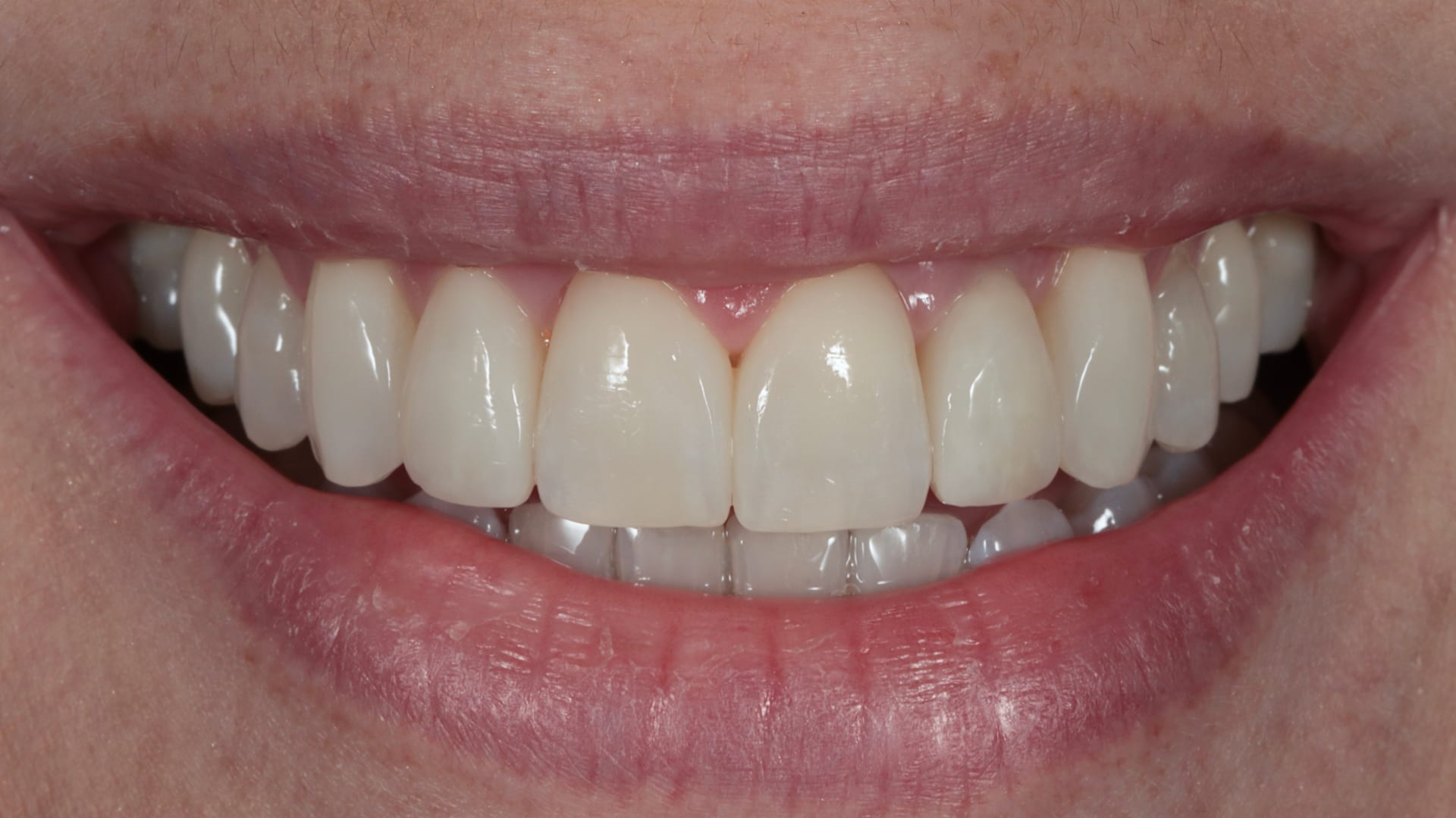 After — Invisalign, whitening & composite bonding — 6 teeth