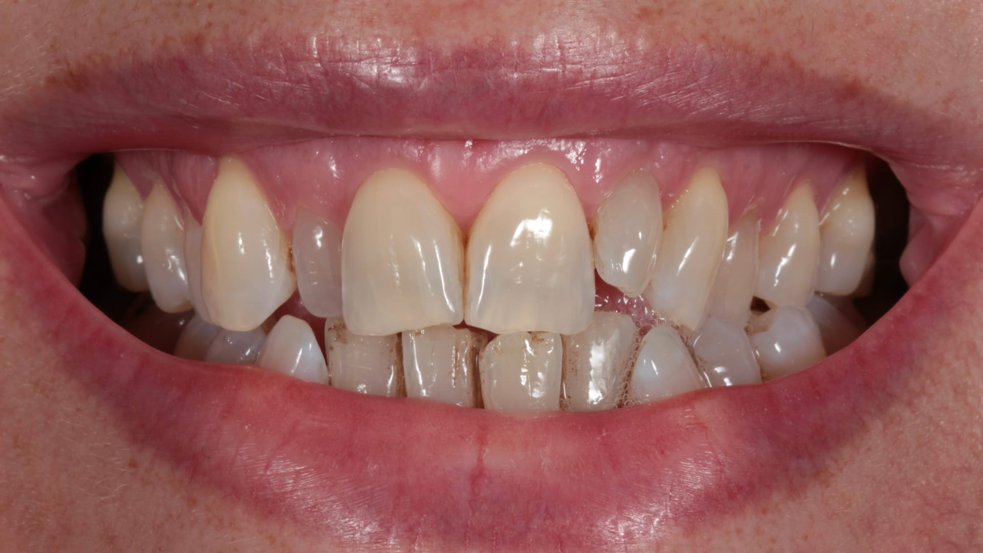 Before — Invisalign, whitening & composite bonding — 6 teeth