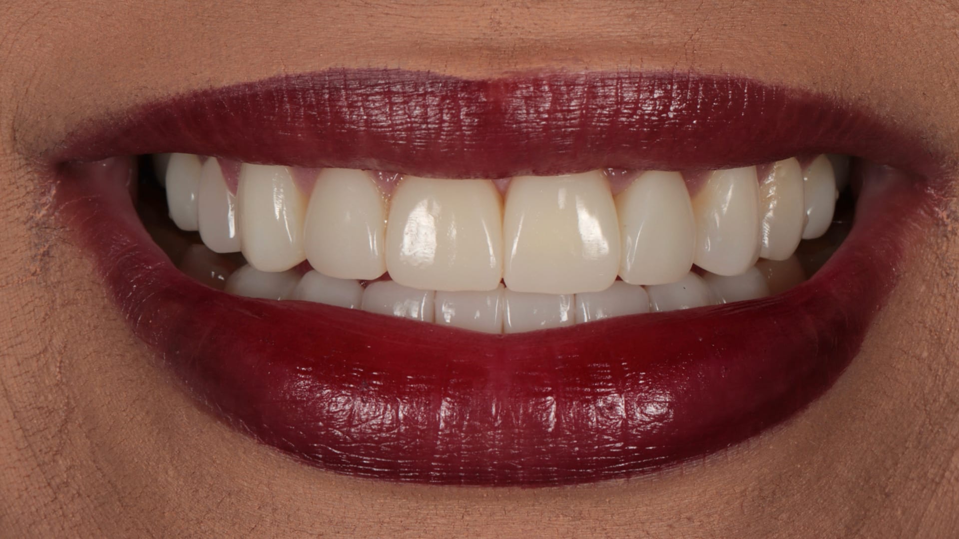After — 24x composite bonding — full mouth rehabilitation