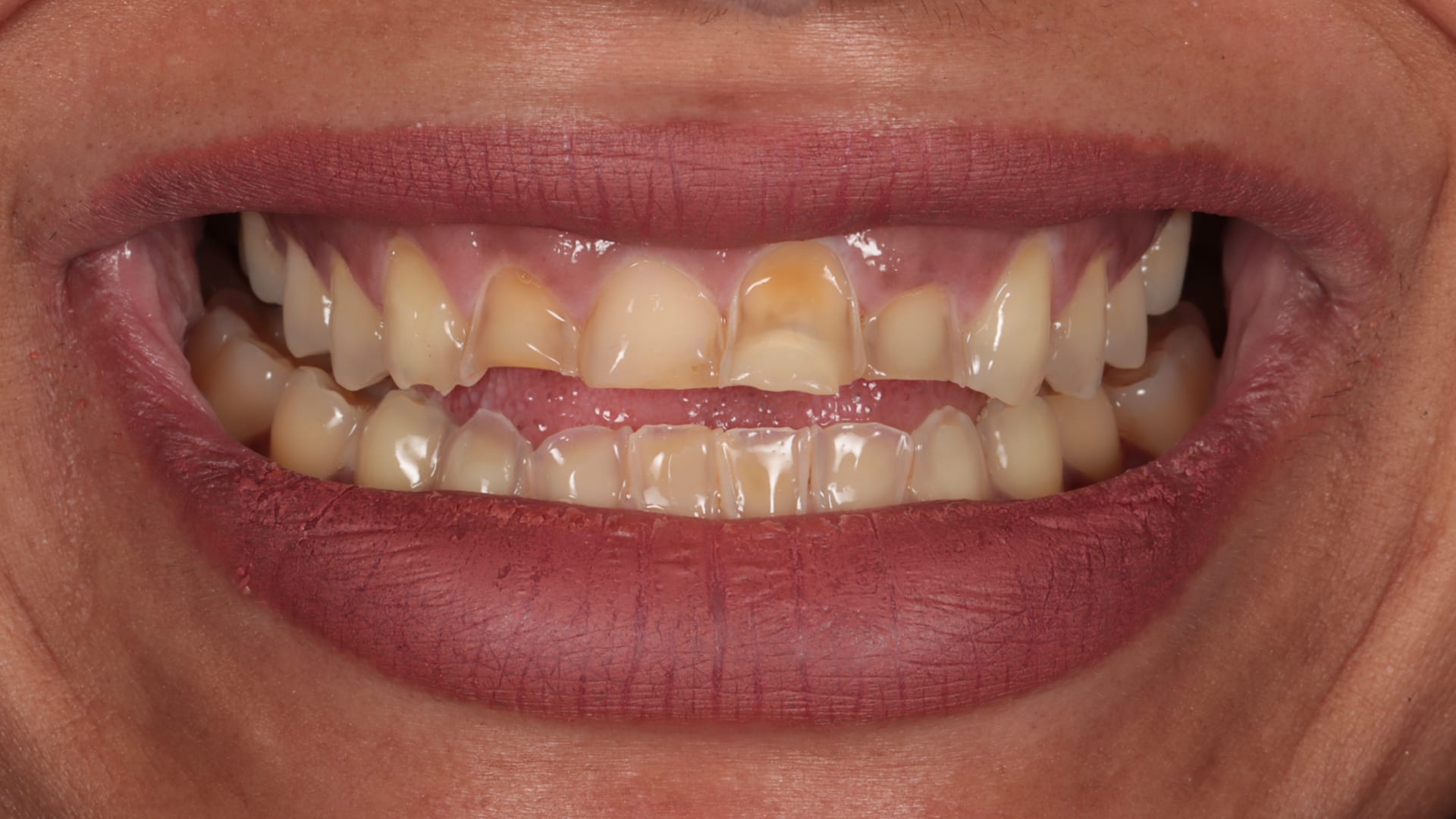 Before — 24x composite bonding — full mouth rehabilitation
