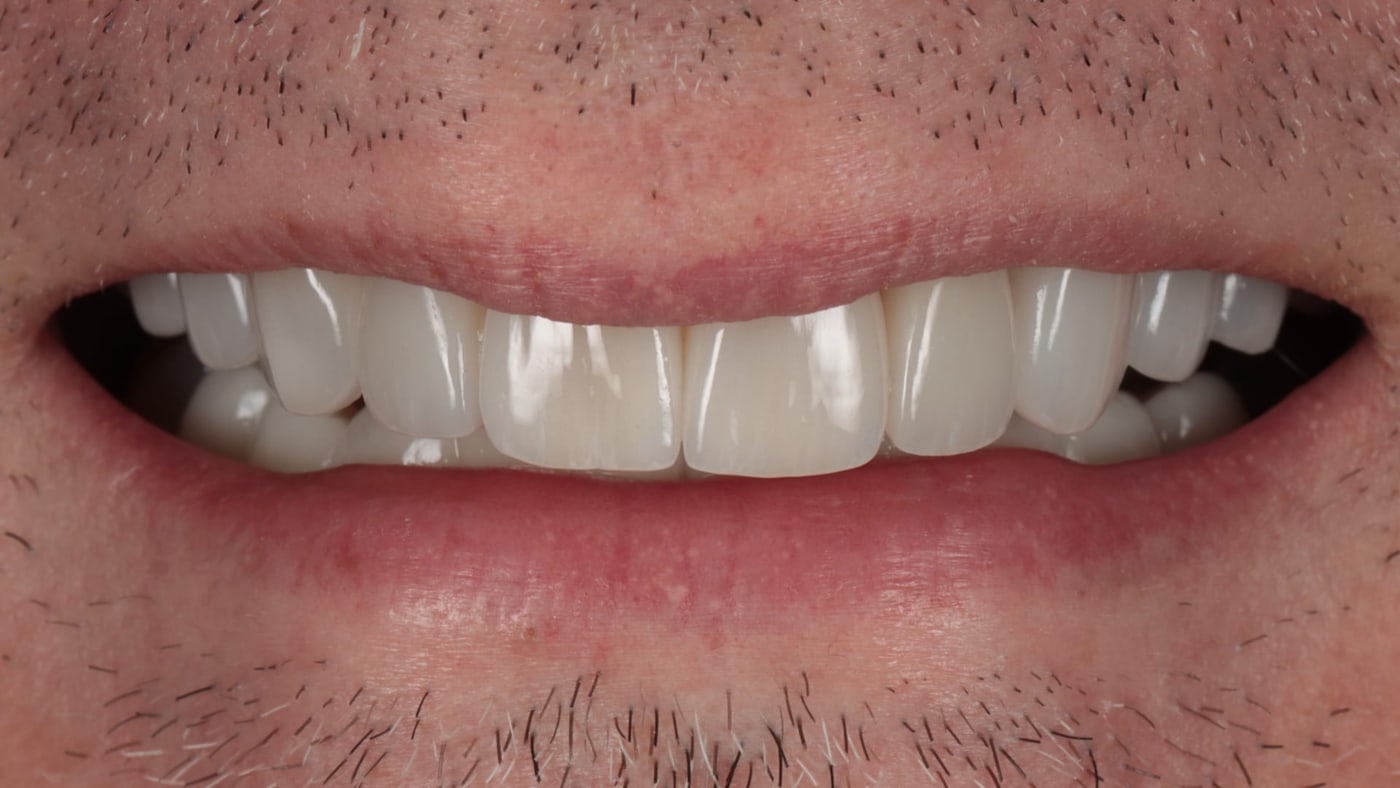 After — Pre-bonding whitening