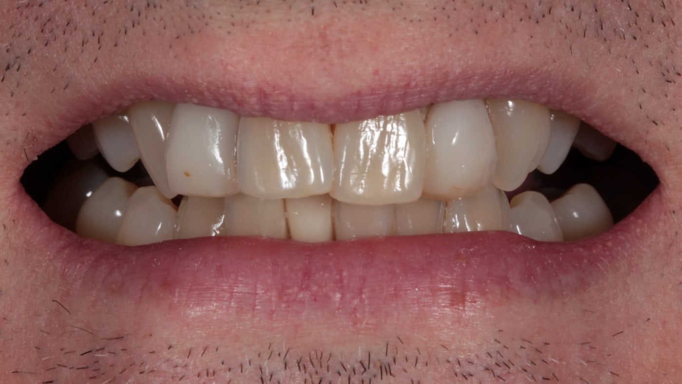 Before — Pre-bonding whitening