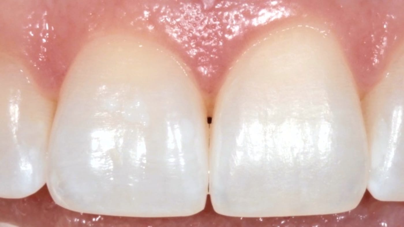 After — A small chip fixed with tooth contouring