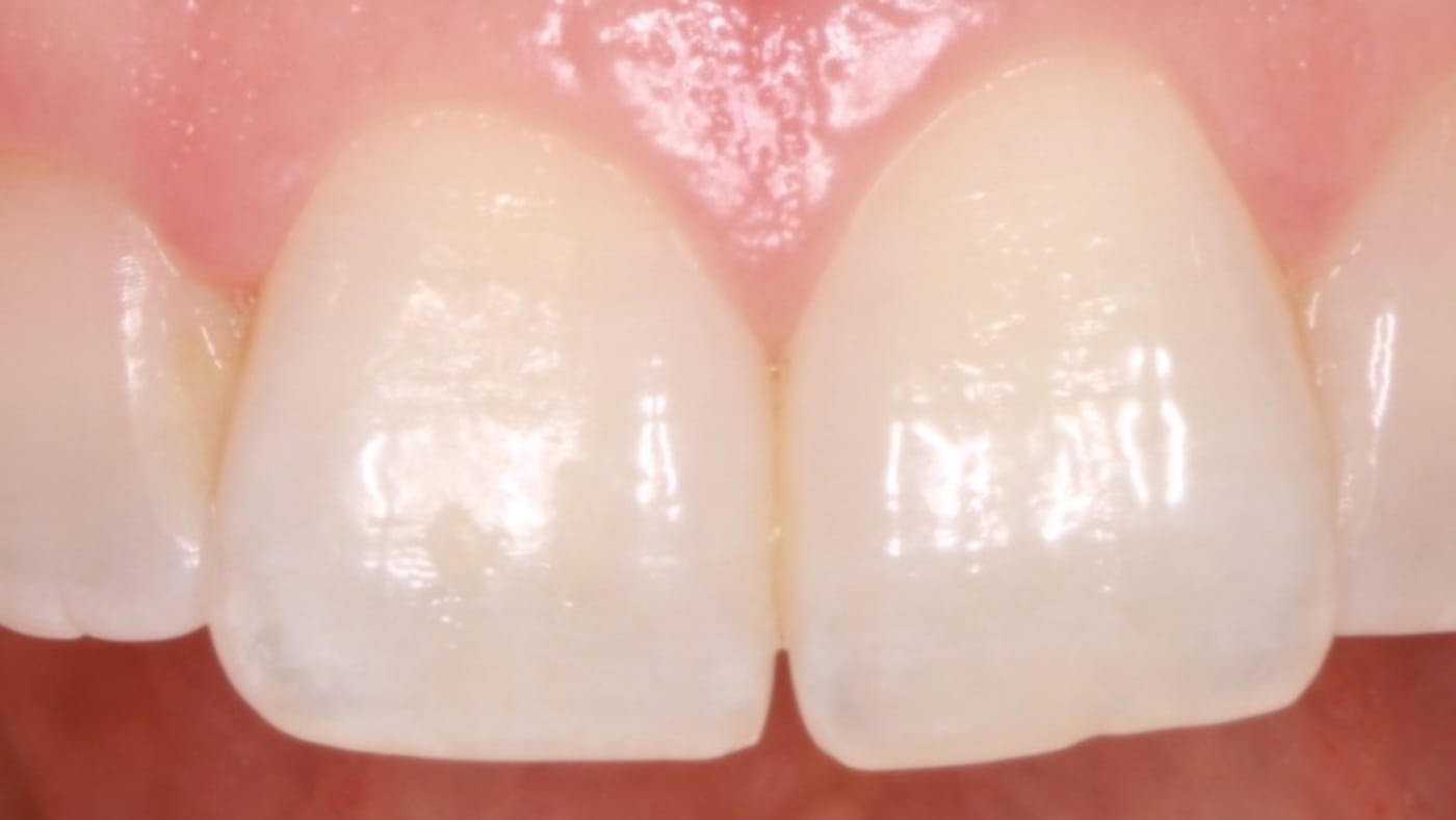 Before — A small chip fixed with tooth contouring