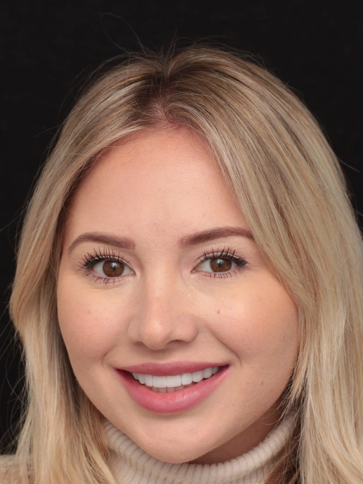 Smile makeover in Windsor by cosmetic dentist Dr. Albert Gajdos
