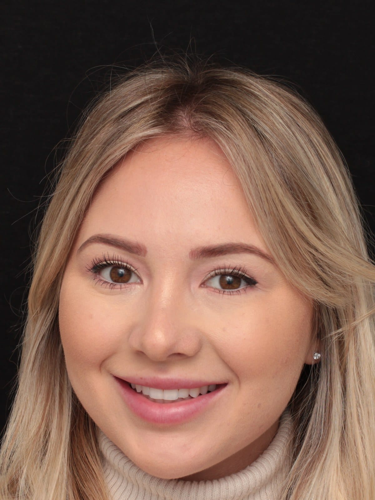 Before — A full-face transformation — designed and hand-sculpted by Dr. Albert