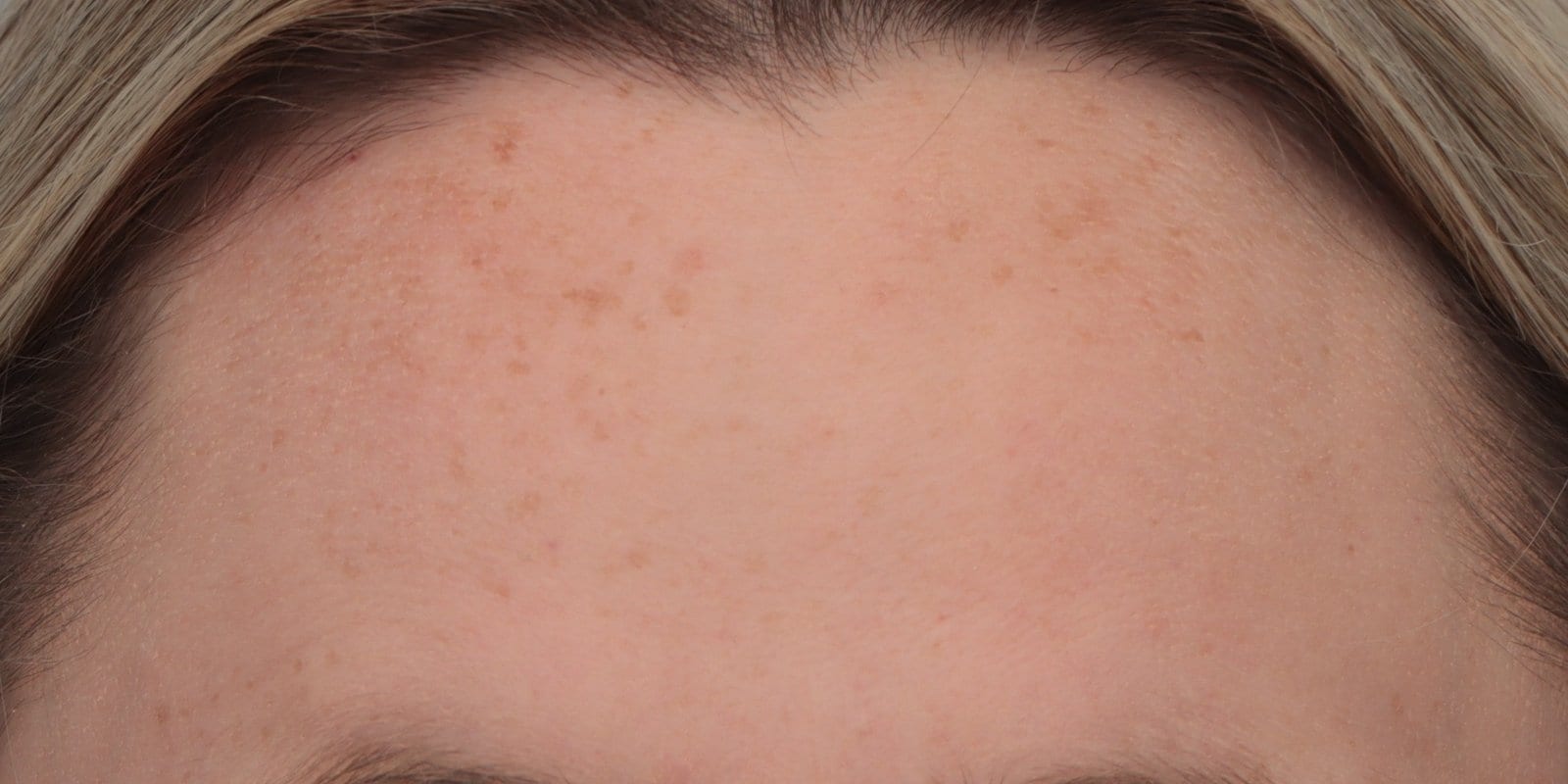 After — Anti-wrinkle injections — forehead lines