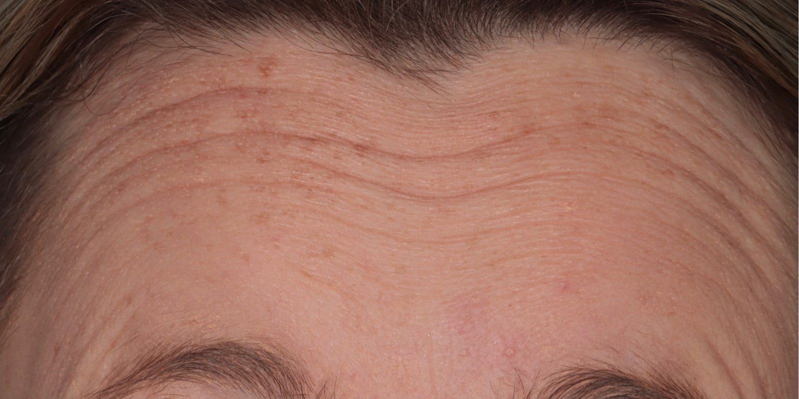 Before — Anti-wrinkle injections — forehead lines