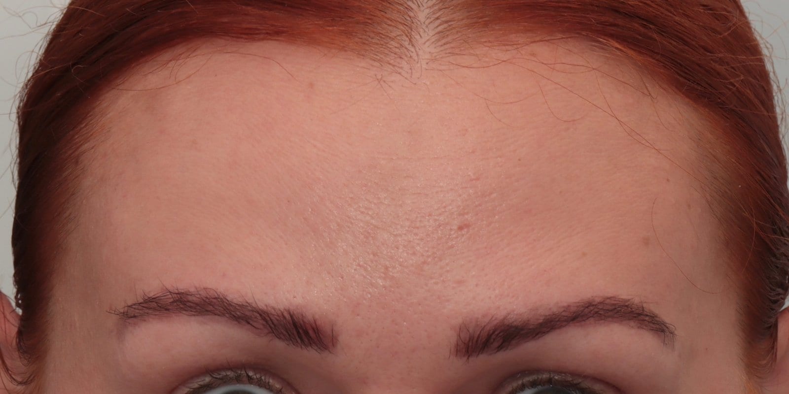 After — Anti-wrinkle injections — deep forehead lines