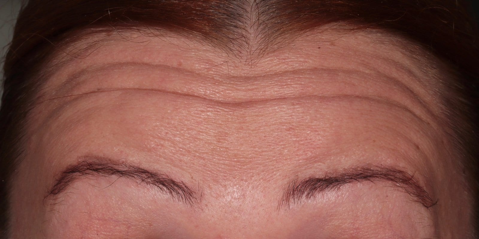 Before — Anti-wrinkle injections — deep forehead lines